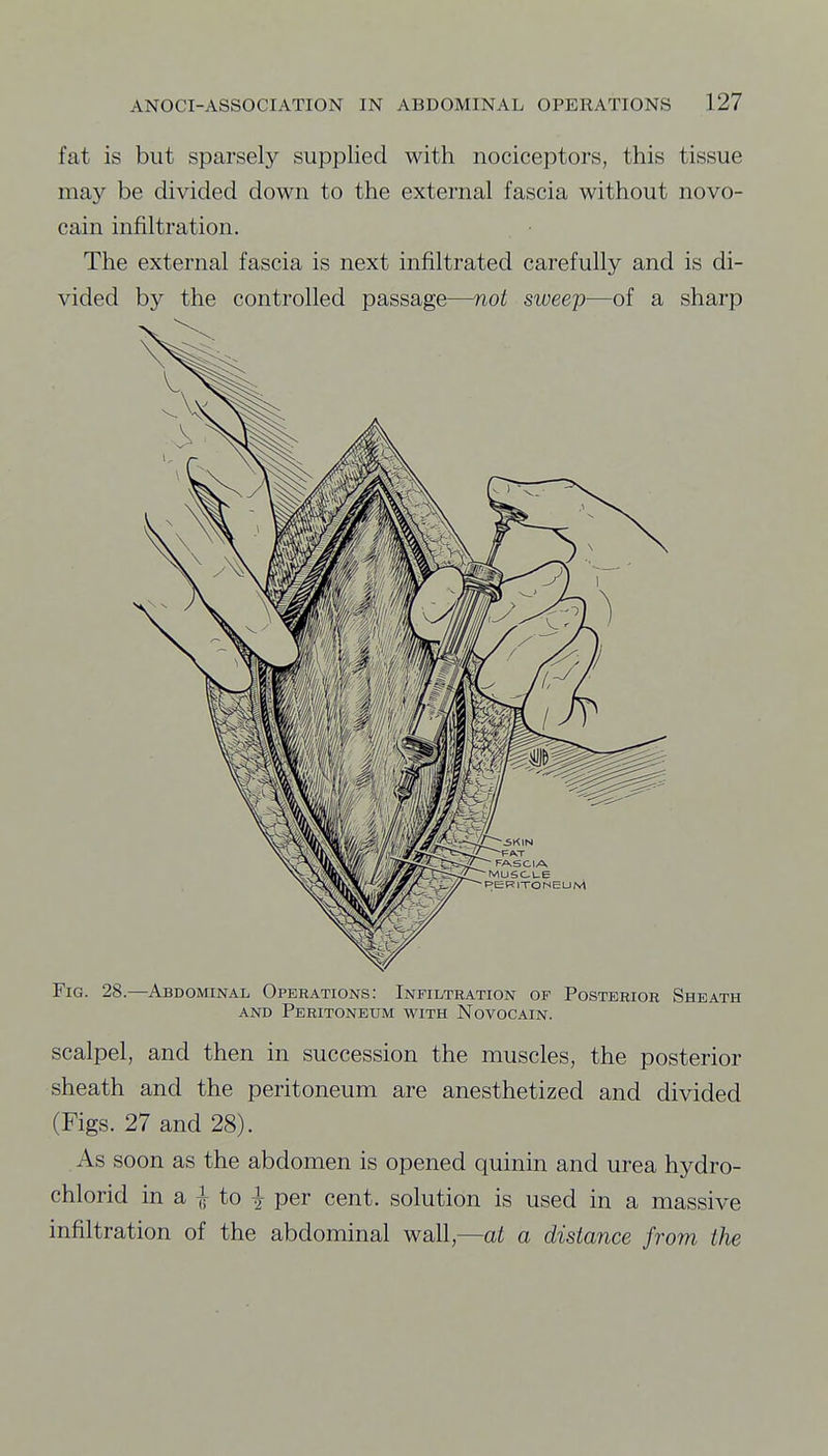 fat is but sparsely supplied with nociceptors, this tissue may be divided down to the external fascia without novo- cain infiltration. The external fascia is next infiltrated carefully and is di- vided by the controlled passage—not sweep—of a sharp Fig. 28.—Abdominal Operations: Infiltration of Posterior Sheath AND Peritoneum with Novocain. scalpel, and then in succession the muscles, the posterior sheath and the peritoneum are anesthetized and divided (Figs. 27 and 28). As soon as the abdomen is opened quinin and urea hydro- chlorid in a i to per cent, solution is used in a massive infiltration of the abdominal wall,—at a distance from the