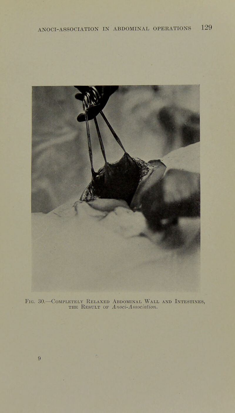 Fig. 30.—Completely Relaxed Abdominal Wall and Intestines, THE Result of Anoci-Association. 9