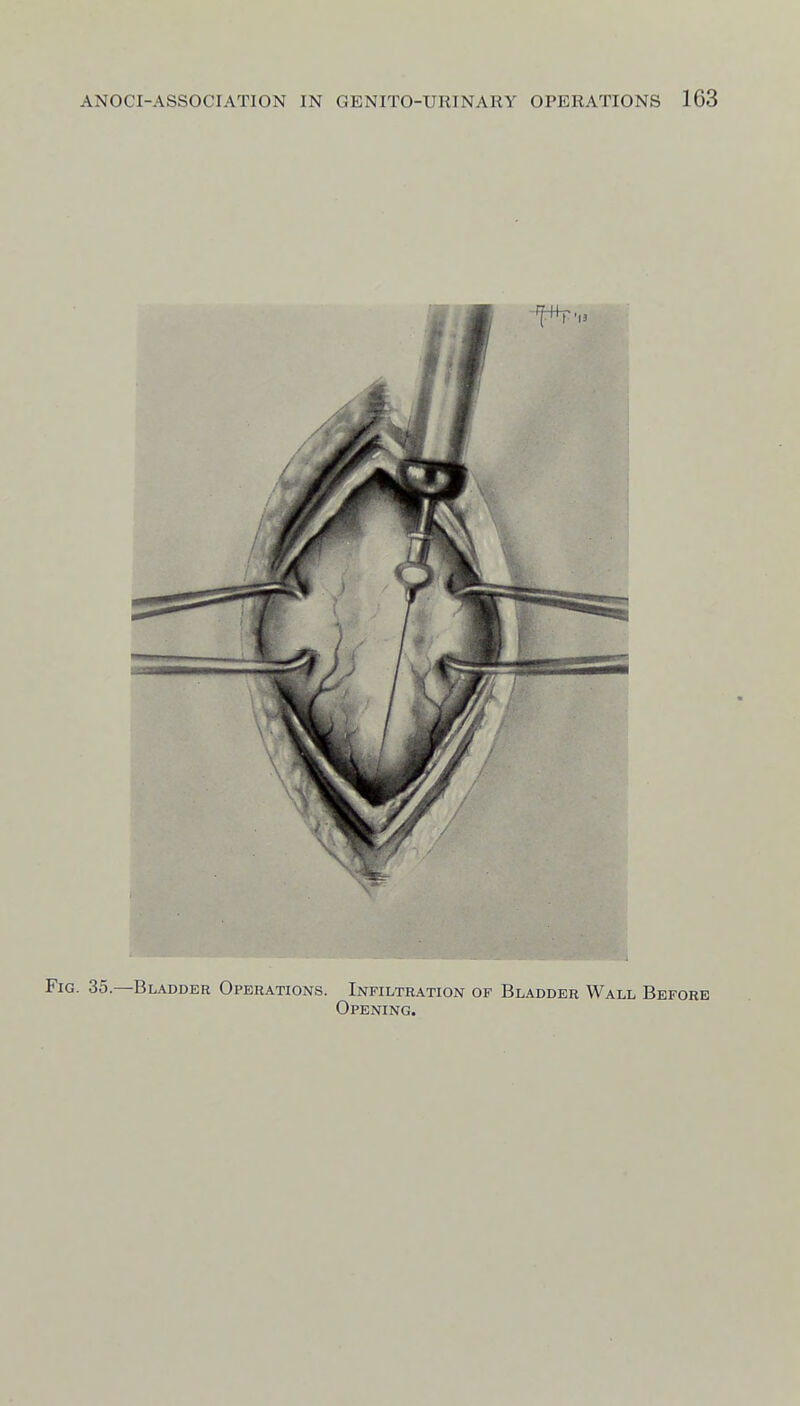 Fig. 35—Bladder Operations. Infiltration op Bladder Wall Before Opening.