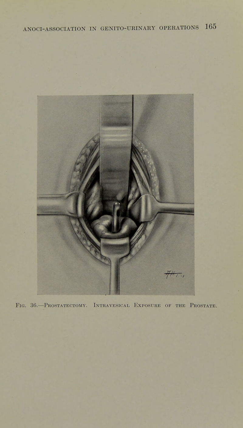 Fig. 36.—Prostatectomy. Intravesical Exposure of the Prostate.