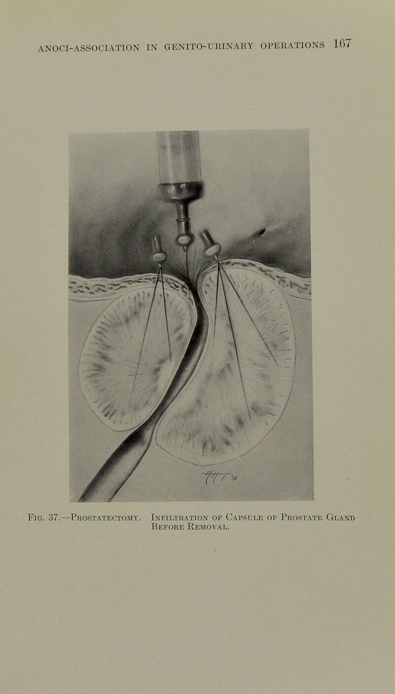 Fig. 37.—Prostatectomy. Infiltration of Capsule of Prostate Gland Before Removal.