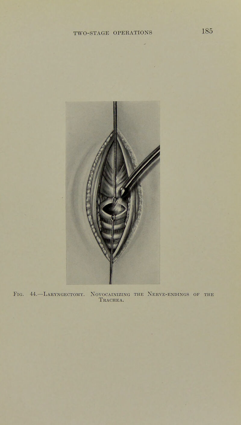 Fig. 44.—Laryngectomy. Novocainizing the Nerve-endings of the Trachea.