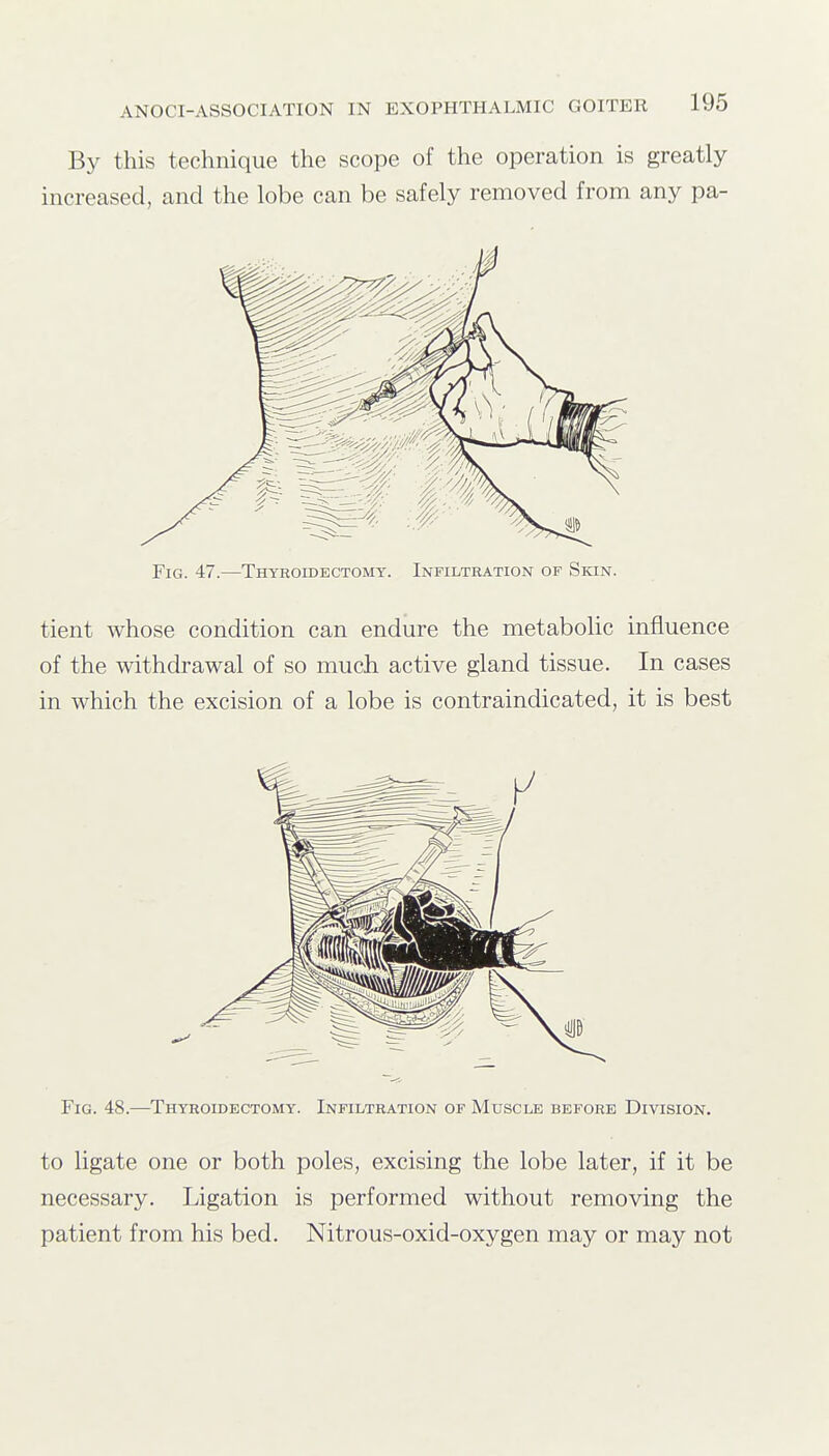 By this technique the scope of the operation is greatly increased, and the lobe can be safely removed from any pa- FiG. 47.—Thyroidectomy. Infiltration of Skin. tient whose condition can endure the metabolic influence of the withdrawal of so much active gland tissue. In cases in which the excision of a lobe is contraindicated, it is best Fig. 48.—Thyroidectomy. Infiltration of Muscle before Division. to ligate one or both poles, excising the lobe later, if it be necessary. Ligation is performed without removing the patient from his bed. Nitrous-oxid-oxygen may or may not