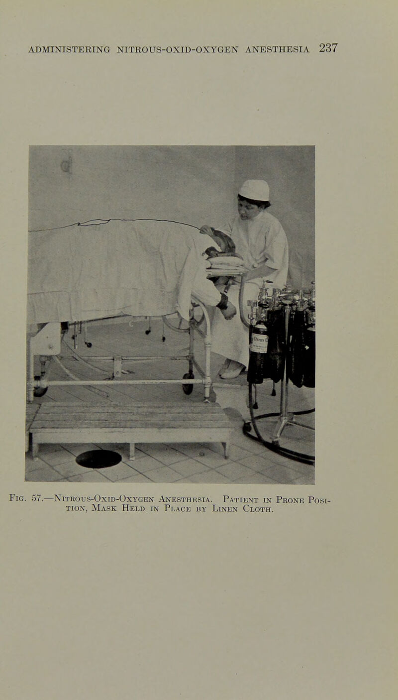 Fig. 57.—Nitrous-Oxid-Oxygen Anesthesia. Patient in Prone Posi- tion, Mask Held in Place by Linen Cloth.