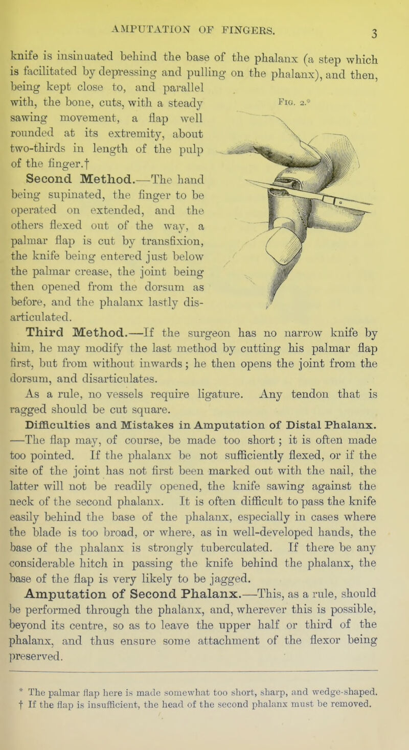 knife is insinuated behind the base of the phalanx (a step which is facilitated by depressing and pulling on the phalanx), and then, being kept close to, and parallel with, the bone, cuts, with a steady Fig- 2.* sawing movement, a flap well ^ ~x rounded at its extremity, about two-thirds in length of the pulp of the finger, t Second Method.—^The hand being supinated, the finger to be operated on extended, and the others flexed out of the way, a palmar flap is cut by transfixion, the knife being entered just below the palmar crease, the joint being then opened from the dorsum as before, and the phalanx lastly dis- articulated. Third Method.—If the surgeon has no narrow knife by him, he may modify the last method by cutting his palmar flap first, but from without inwards; he then opens the joint from the dorsum, and disarticulates. As a rule, no vessels require ligature. Any tendon that is ragged should be cut square. Difficulties and Mistakes in Amputation of Distal Phalanx. —The flap may, of course, be made too short; it is often made too pointed. If the phalanx be not sufficiently flexed, or if the site of the joint has not first been marked out with the nail, the latter will not be readily opened, the knife sawing against the neck of the second phalanx. It is often difficult to pass the knife easily behind the base of the phalanx, especially in cases where the blade is too broad, or where, as in well-developed hands, the base of the phalanx is strongly tuberculated. If there be any considerable hitch in passing the knife behind the phalanx, the base of the flap is very likely to be jagged. Amputation of Second Phalanx.—This, as a rule, should 1)6 performed through the phalanx, and, wherever this is possible, beyond its centre, so as to leave the upper half or third of the phalanx, and thus ensure some attachment of the flexor being preserved. * The palmar flap bore is made soiuewhat too short, sharp, and wedge-shaped, t If the flap is insufficient, the head of the second phahmx must be removed.