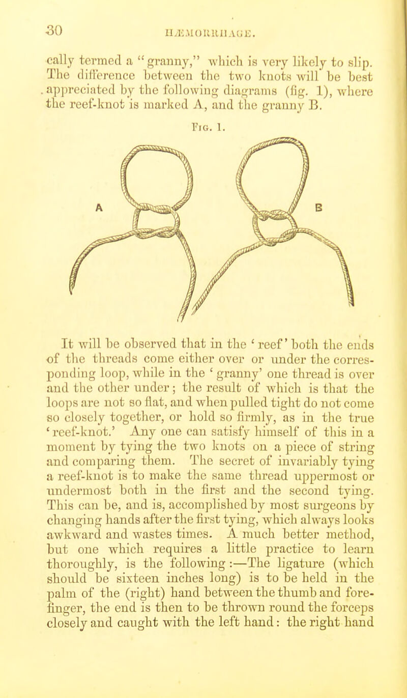 so n^KJIOIlllIlAUl:;. cally termed a  granny, which is very likely to slip. The difference between the two knots will be best .appreciated by the following diagrams (fig. 1), where the reef-knot is marked A , and the granny B. Pig. 1. It will be observed that in the ' reef both the ends of tlie threads come either over or under the corres- ponding loop, while in the ' granny' one thread is over and the other under; the result of wdiich is that the loops are not so flat, and when pulled tight do not come so closely together, or hold so fii'mly, as in the true * reef-knot.' Any one can satisfy himself of this in a moment by tying the two knots on a piece of string and comparing them. The secret of invariably tying a reef-knot is to make the same thread uppermost or undermost both in the first and the second tying. This can be, and is, accomplished by most surgeons by changing hands after the first tying, which always looks awkward and wastes times. A much better method, but one which requires a little practice to learn thoroughly, is the following :—The ligature (which should be sixteen inches long) is to be held in the palm of the (right) hand between the thumb and fore- finger, the end is then to be thrown round the forceps closely and caught with the left hand: the right hand