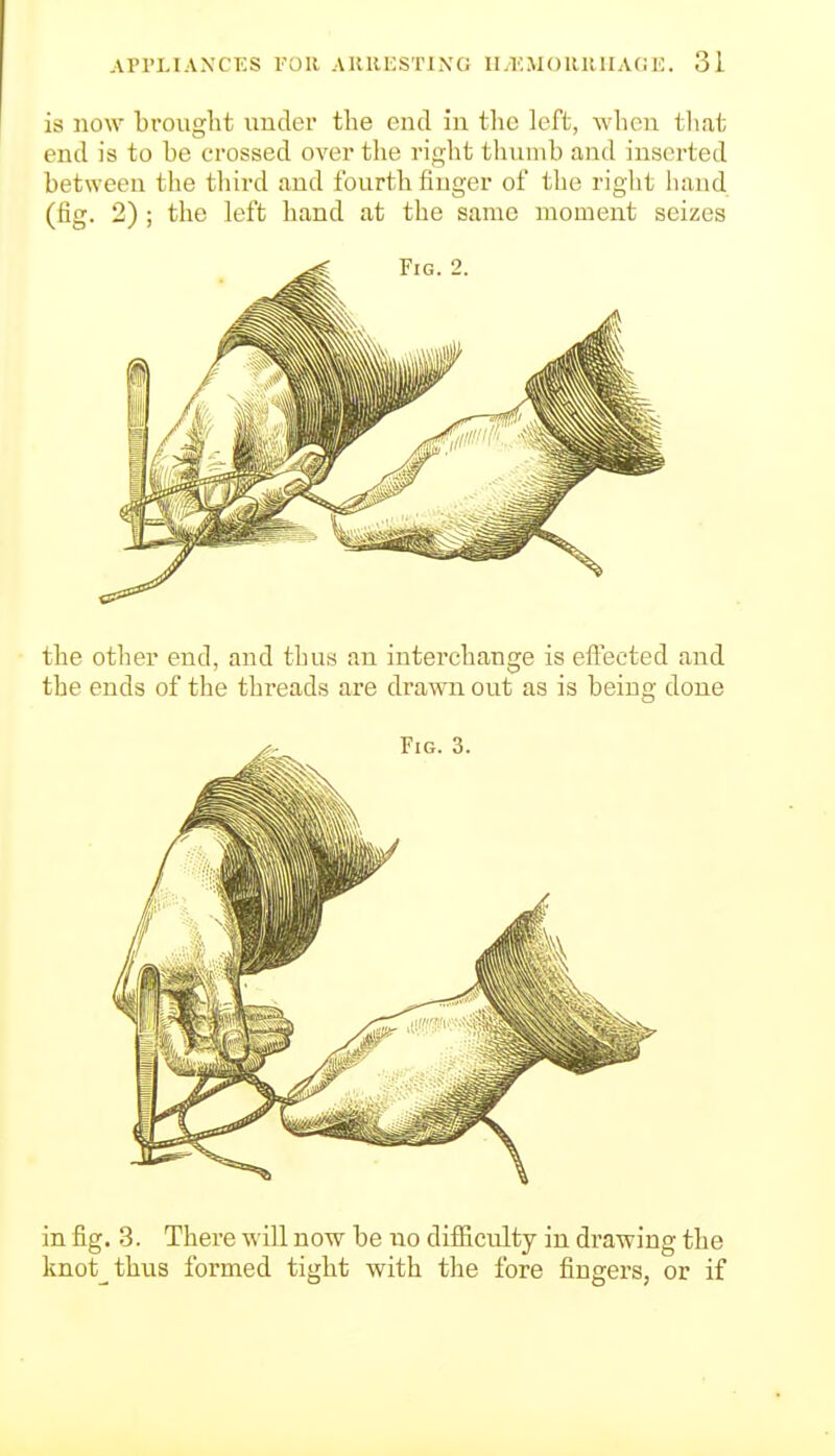 is now brought under the end in the left, when tliat end is to be crossed over the right tliuinb and inserted between the tliird and fourth finger of the right luind (fig. 2); the left hand at the same moment seizes the otlier end, and thus an interchange is effected and the ends of the threads are drawn out as is being done in fig. 3. There will now be no difiiculty in drawing the knot^thus formed tight with the fore fingers, or if