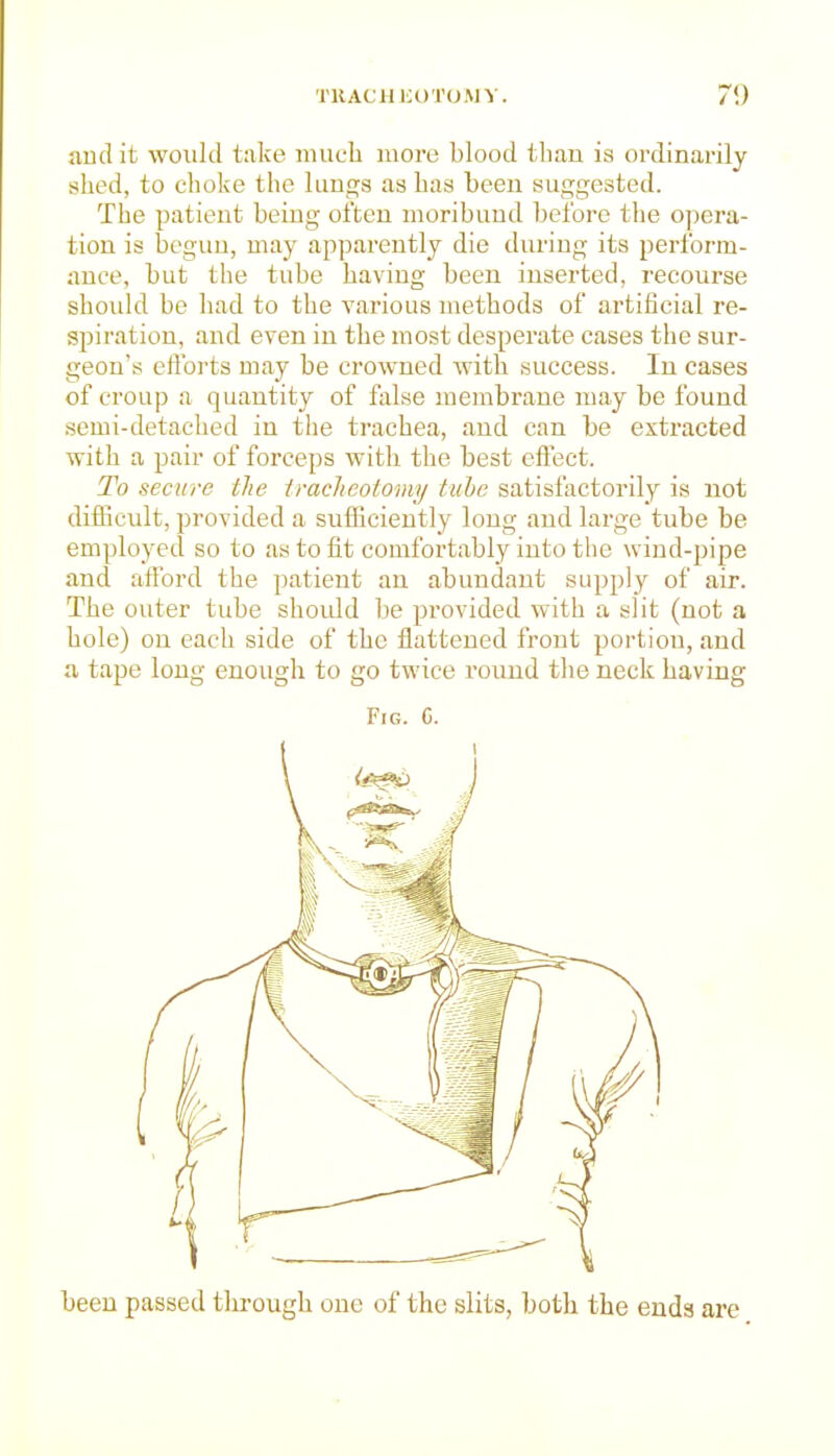 audit would take nuich more blood tlian is ordinarily shed, to choke the lungs as has been suggested. The patient being often moribund before the opera- tion is begun, may apparently die during its perform- ance, but the tube having been inserted, recourse should be had to the various methods of artificial re- spiration, and even in the most desperate cases the sur- geon's efforts may be crowned with success. In cases of croup a quantity of false membrane may be found .semi-detached in tlie trachea, and can be extracted with a pair of forceps with the best effect. To secure the tracheotomy tube satisfactorily is not difficult, provided a suflficieutly long and large tube be employed so to as to fit comfortably into the wind-pipe and afford the patient an abundant supjjly of air. The outer tube should be provided with a slit (not a hole) on each side of the flattened front portion, and a tape long enough to go twice round the neck having Fig. C. been passed through one of the slits, both the ends are
