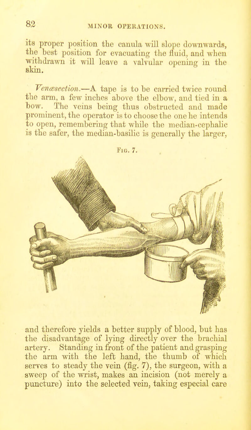 83 its proper position the cauula will slope downwards, the best position for evacuating the fluid, and when withdrawn it will leave a valvular opening in the skin. Vencesection.—A tape is to be carried twice round the arm, a few inches above the elbow, and tied in a bow. The veins being thus obstructed and made prominent, the operator is to choose the one he intends to open, remembering that while the median-cephalic is the safer, the median-basilic is generally the larger, Fig. 7. and therefore yields a better supply of blood, but has the disadvantage of lying directly over the brachial artery. Standing in front of the patient and grasping the arm with the left hand, the thumb of which serves to steady the vein (fig. 7), the surgeon, wdth a sweep of the wrist, makes an incision (not merely a punctuje) into the selected vein, taking especial care