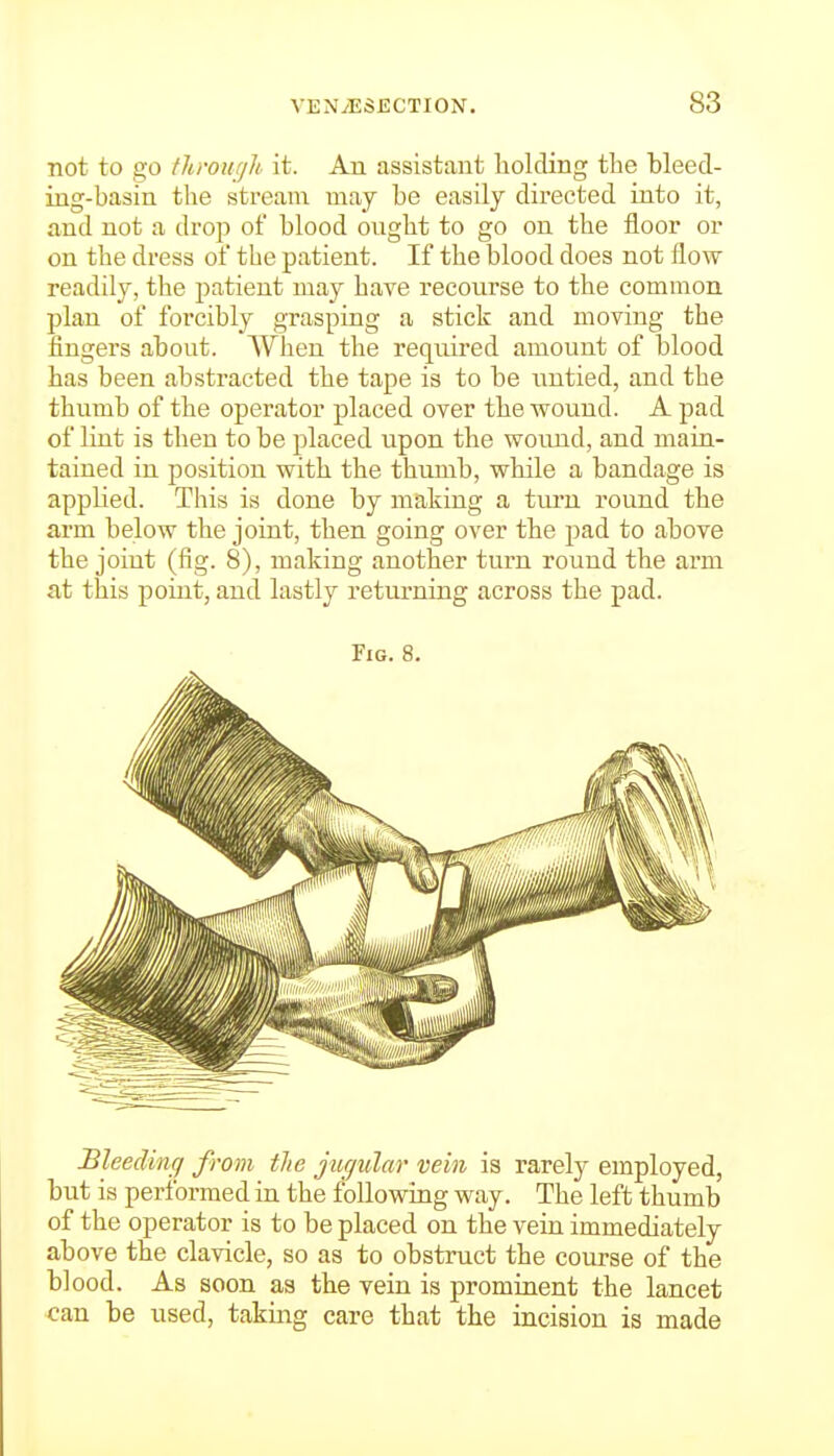 not to go throufjh it. An assistant liolding the bleed- ing-basin the stream may be easily directed into it, and not a drop of blood ought to go on the floor or on the dress of the patient. If the blood does not flow readily, the patient may have recourse to the common plan of forcibly grasping a stick and moving the fingers about. When the required amount of blood has been abstracted the tape is to be untied, and the thumb of the operator placed over the wound. A pad of lint is then to be placed upon the wound, and main- tained in position with the thumb, while a bandage is applied. This is done by making a turn round the arm below the joint, then going over the pad to above the joint (fig. 8), making another turn round the arm at this point, and lastly returning across the pad. Fig. 8. Bleeclinf) from the jugular vein is rarely employed, but is performed in the following way. The left thumb of the operator is to be placed on the vein immediately above the clavicle, so as to obstruct the course of the blood. As soon as the vein is prominent the lancet can be used, taking care that the incision is made
