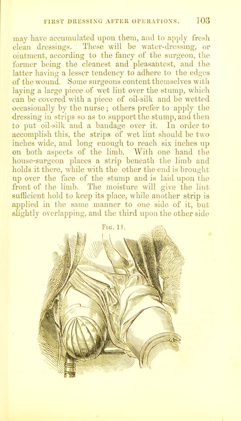 luay have accumulated upou thein, aud to apply I'rcsli clean dressings. These will be water-dressing, or ointment, according to the fancy of the surgeon, the former being the cleanest and pleasantest, and the latter having a lesser tendency to adhere to the edges of the wound. Some surgeons content themselves with laying a large piece of wet lint over the stump, w^hich can be covered with a piece of oil-silk and be wetted occasionally by the nurse; others prefer to apply the dressing in strips so as to support the stump, and then to put oil-silk and a bandage over it. In order to accomplish this, the strips of wet lint should be two inches wide, and long enough to reach six inches up on both aspects of the limb. With one hand the house-surgeon ])laces a strip beneath the limb and bolds it there, while with the other the end is brought up over the face of the stump and is laid upon the front of the limb. The moisture will give the lint sufficient hold to keep its place, while another strip is applied in the same manner to one side of it, but slightly overlapping, and the third upon the other side