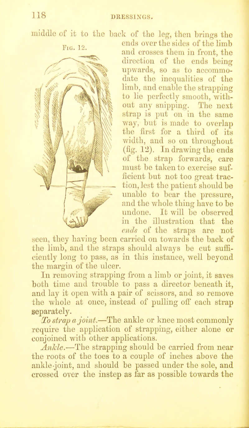 Fig. i: middle of it to the back of the leg, then brings the cuds over the sides of the limb and crosses them in front, the direction of the ends being upwards, so as to accommo- date the inequalities of the limb, and enable the strapping to lie perfectly smooth, Avith- out any snipping. The next strap is put on in the same way, but is made to overlap the first for a third of its width, and so on throughout (fig. 12). In drawing the ends of the strap forwards, care must be taken to exercise suf- ficient but not too great trac- tion, lest the patient shoidd be unable to bear the pressure, and the whole thing have to be undone. It will be observed in the illustration that the cnch of the straps are not seen, they having been carried on towards the back of the limb, and the straps should always be cut suffi- ciently long to pass, as in this instance, well beyond the margin of the ulcer. In removing strapping from a limb or joint, it saves both time and trouble to pass a director beneath it, and lay it open Avith a pair of scissors, and so remove the whole at once, instead of pulling off each sti-ap separately. To strap a joint.—The ankle or knee most commonly require tlie application of strapping, either alone or conjoined with other applications. Anide.—The strapping should be carried from near the roots of the toes to a couple of inches above the ankle-joint, and should be passed under the sole, and crossed over the instep as far as possible towards the