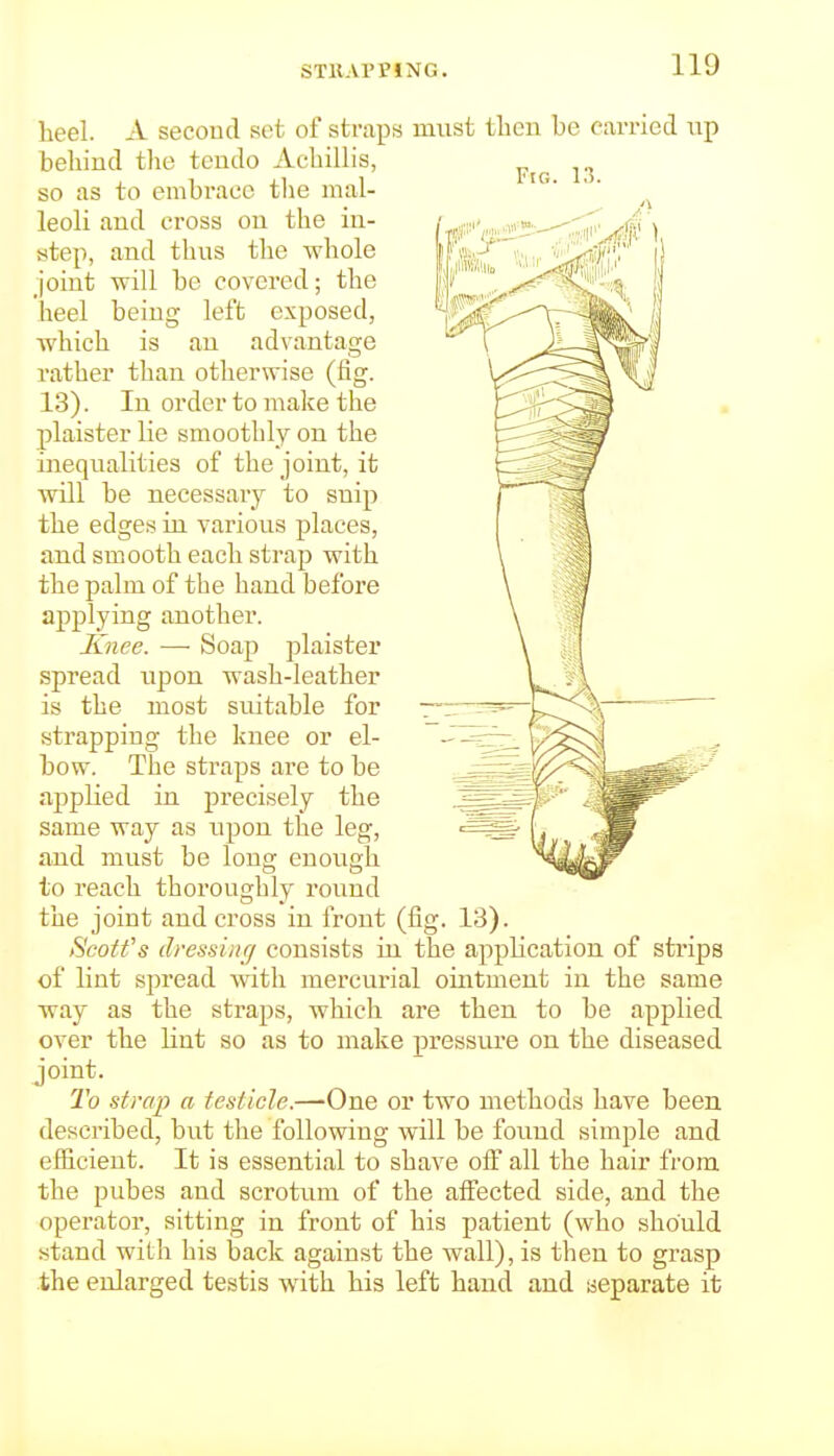 heel. A second set of straps must tlicn be carried np behind the tendo Achillis, so as to embrace tlie mal- leoli and cross on the in- step, and thus the whole joint -will be covered; the heel being left exposed, Avhich is an advantage rather than otherwise (fig. 13). In order to make the plaister lie smoothly on the inequalities of the joint, it will be necessary to snip the edges in. various places, and smooth each strap with the palm of the hand before applying another. Knee. — Soap plaister •spread upon wash-leather is the most suitable for strapping the knee or el- bow. The straps are to be applied in precisely the same way as upon the leg, and must be long enough to reach thoroughly round the joint and cross in front (fig. 13). tSeotfs dressing consists in the application of strips of lint spread with mercurial ointment in the same way as the stra2)s, which are then to be applied over the lint so as to make pressure on the diseased joint. 2'o strap a testicle.—One or two methods have been described, but the following will be found simple and efficient. It is essential to shave off all the hair from the pubes and scrotum of the affected side, and the operator, sitting in front of his patient (who should stand with his back against the wall), is then to grasp the enlarged testis with his left hand and separate it