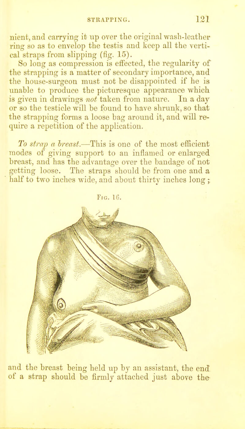 nient, and carrying it up over the original wash-leather ring so as to envelop tlie testis and keep all the verti- cal straps from slipping (fig. 15). So long as compression is efiected, the regularity of the strapping is a matter of secondary importance, and the house-surgeon must not be disappointed if he is unable to produce the picturesque appearance which is given in drawings nof taken from nature. In a day or so the testicle will be found to have shrunk, so that the stra])ping forms a loose bag around it, and will re- quire a repetition of the application. To strap a hreasf.—This is one of the most efficient modes of giving support to an inflamed or enlarged breast, and has the advantage over the bandage of not getting loose. The straps should be from one and a half to two inches wide, and about thirty inches long - Fig. Ifi. and the breast being held up by an assistant, the end of a strap should be firmly attached just above the