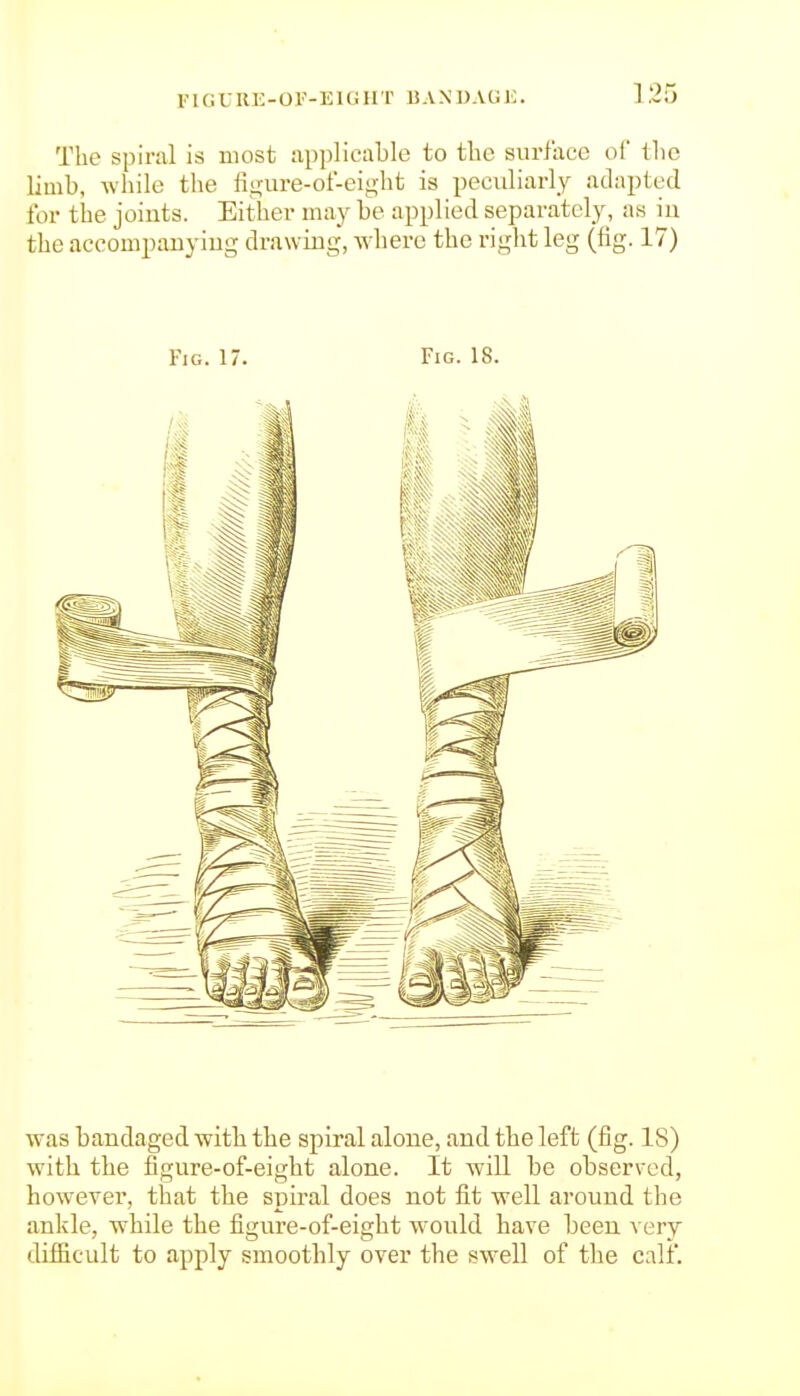 FIG t; RE - OF-E1G H T IJ A N1) A G K. The spiral is most applicable to the surface of tlie limb, while the fi<^ure-of-eight is peculiarly adapted for the joints. Either may be applied separately, aw in the accompanyiug drawing, where the right leg (fig. 17) Fig. 17. Fig. 18. was bandaged witli the spiral alone, and the left (fig. IS) with the figure-of-eight alone. It will be observed, however, that the spiral does not fit well around the ankle, while the figure-of-eight would have been very dif&cult to apply smoothly over the swell of the calf.
