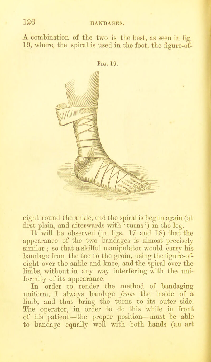 A combination of tlie two is the best, as seen in fig. 19, where, the spiral is used in the foot, the figure-of- FiG. 19. eight round the ankle, and the spiral is begun again (at first plain, and afterwards with ' tui'ns') in the leg. It will be observed (in figs. 17 and 18) that the appearance of the two bandages is almost precisely- similar ; so that a skilful manipulator would carry his bandage from the toe to the groin, using the figure-of- eight over the ankle and knee, and the spiral over the limbs, without in any way interfering with the uni- formity of its appearance. In order to render the method of bandaging uniform, I always bandage from the iuside of a limb, and thus bring the turns to its outer side. The operator, in order to do this while in front of his patient—the proper position—must be able to bandage equally well with both hands (an art