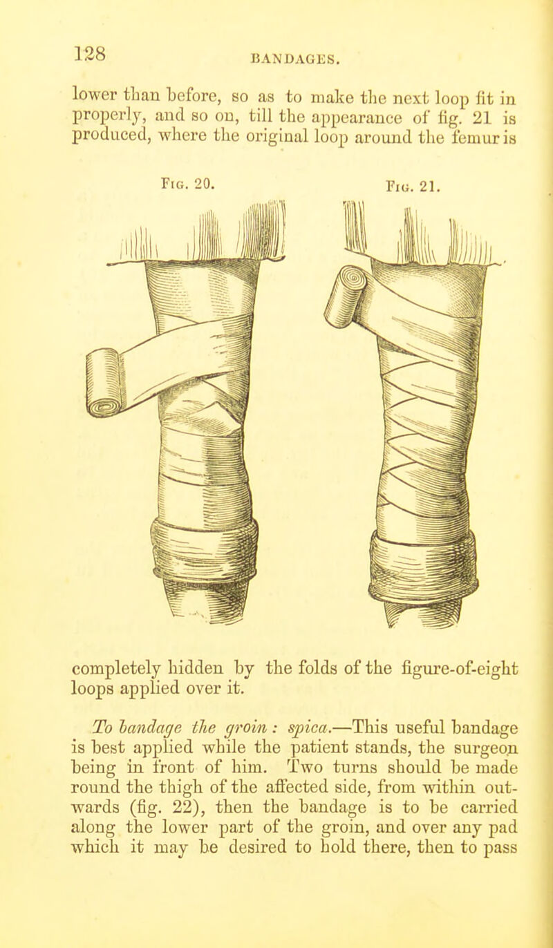 lower than before, so as to make the next loop fit in properly, and so on, till the appearance of fig. 21 is produced, where the original loop around the femur is Fig. 20. F,o. 21. completely hidden by the folds of the figure-of-eight loops applied over it. To landage the groin : spica.—This useful bandage is best applied while the patient stands, the surgeon being in front of him. Two turns should be made round the thigh of the affected side, from within out- wards (fig. 22), then the bandage is to be carried along the lower part of the groin, and over any pad which it may be desired to hold there, then to pass