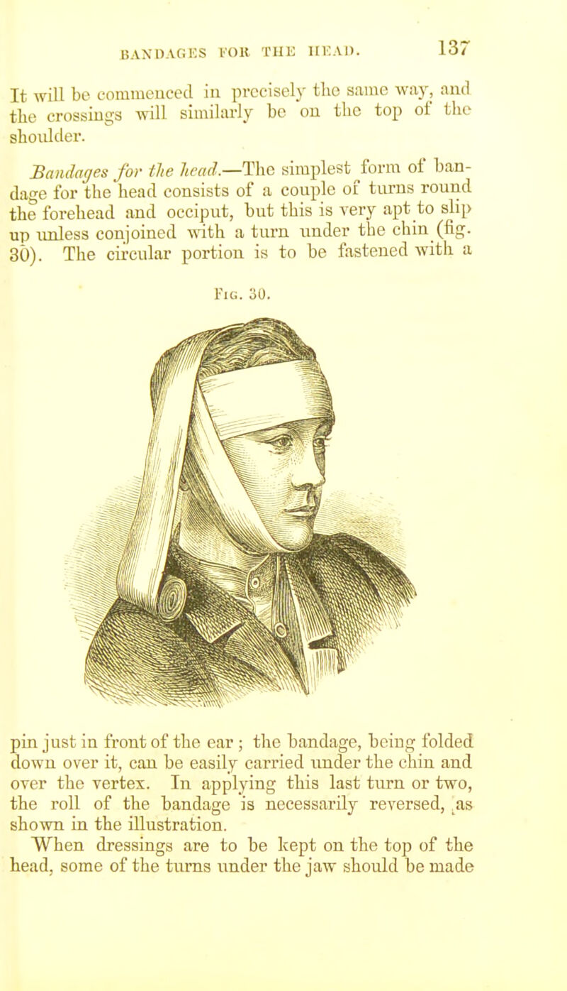BANOAC-.KS I'OK THE UF.AI). It will be fomraeuced in precisely the same way, and the crossings will similarly be on the top of the shoidder. Bandages for tie licaA—Ti^Q simplest form of ban- dage for the head consists of a couple of turns round the forehead and occiput, but this is very apt to slip up unless conjoined a turn imder the chin (fig. 30). The circular portion is to be fastened with a Fig. 30. pin just in front of the ear ; the bandage, being folded down over it, can be easily carried under the chin and over the vertex. In applying this last turn or two, the roll of the bandage is necessarily reversed, ,as shown in the illustration. When dressings are to be kept on the top of the head, some of the turns under the jaw should be made