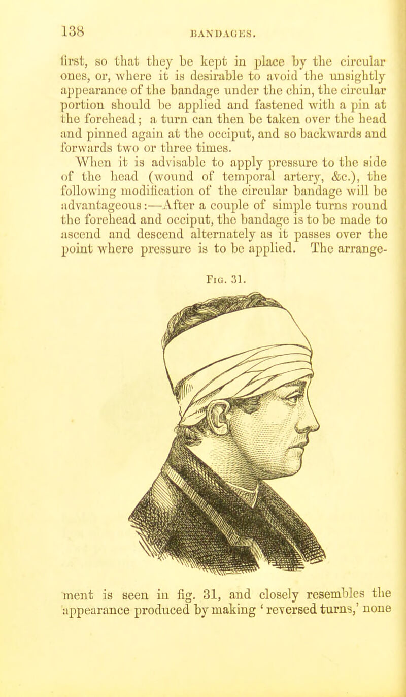 tii'st, BO that tlioy be kept in place by the circular ones, or, where it is desirable to avoid the unsightly- appearance of the bandage under tlie chin, the circular portion should be applied and fastened with a pin at the forehead; a turn can then be taken over the head and pinned again at the occiput, and so backwards and forwards two or three times. When it is advisable to apply pressure to the side of the head (wound of tem])oral artery, &c.), the following luodihcation of the circular bandage Avill be advantageous:—After a couple of simple turns roirnd the forehead and occiput, the bandage is to be made to ascend and descend alternately as it passes over the point where pressure is to be applied. The arrange- FiG. 31. ment is seen in fig. 31, and closely resembles the appearance produced by making ' reversed turns,' none