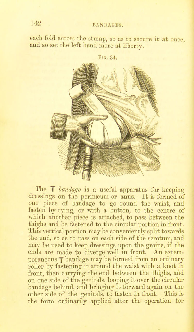 each fold across the stump, so as to secure it at ouci', and so set the left hand more at liberty. Fig. 31. The T handagc is a useful apparatus for keeping dressings on tho perineum or anus. It is formed of one piece of bandage to go round the waist, and fasten by tying, or Avith a button, to the centre of which another piece is attacbed, to pass between the thighs and be fastened to the circular portion in front. This vertical portion may be conveniently split towards the end, so as to pass on each side of the scrotum, and may be used to keep dressings upon the groins, if the ends are made to diverge well in front. An extem- poraneous X bandage may be formed from an ordinary roller by fastening it around the waist wdth a knot in front, then carrying the end between the thighs, and on one side of the genitals, looping it over the circular bandage behind, and bringing it forward again on the other side of the genitals, to fasten in front. This is the form ordinai'ily applied after the operation for
