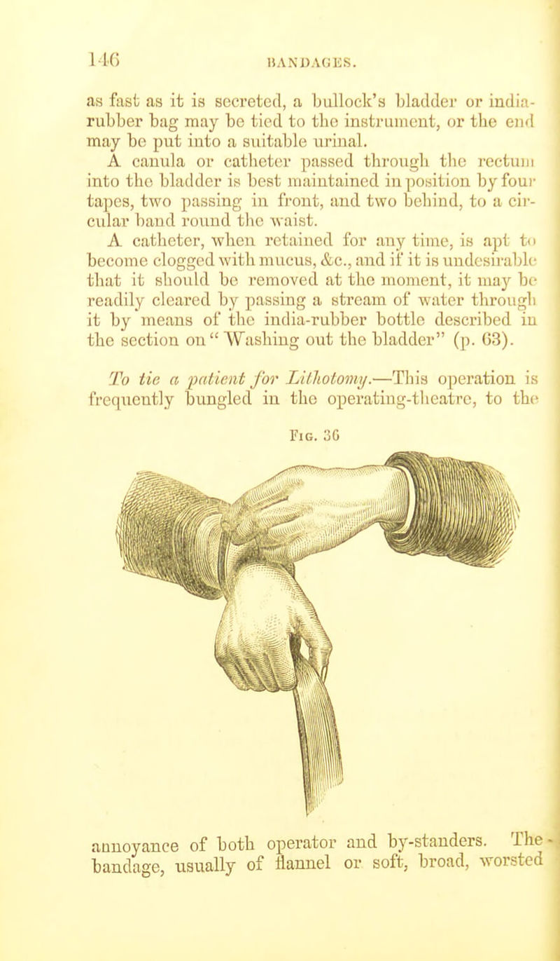 as fast as it is secreted, a bullock's bladder or india- rubber bag may be tied to the instrumeut, or the end may be put into a suitable urinal. A cauula or catheter passed through tlie rectum into the bladder is best maintained in position by four tapes, two passing in front, and two behind, to a cir- cular band round the waist. A catheter, when retained for any time, is apt to become clogged with mucus, &c., and if it is undcsirabh- that it should be removed at the moment, it may be readily cleared by passing a stream of water through it by means of the india-rubber bottle described in the section on Washing out the bladder (p. 63). To tie a patient for Lithotomy.—This operation is freqiiontly bungled in the operating-theatre, to the Fig. 30 annoyance of both operator and by-stauders. The bandage, usually of flannel or soft, broad, worsted