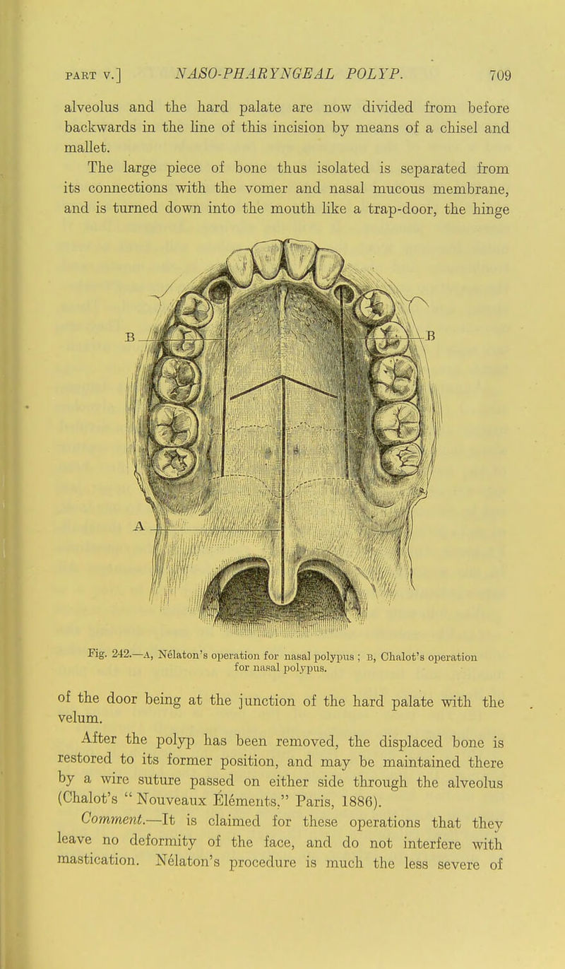 alveolus and the hard palate are now divided from before backwards in the line of this incision by means of a chisel and mallet. The large piece of bone thus isolated is separated from its connections with the vomer and nasal mucous membrane, and is turned down into the mouth like a trap-door, the hinge Fig. 242. a, Nelaton's operation for nasal polypus ; b, Chalot's operation for nasal polypus. of the door being at the junction of the hard palate with the velum. After the polyp has been removed, the displaced bone is restored to its former position, and may be maintained there by a wire suture passed on either side through the alveolus (Chalot's  Nouveaux Elements, Paris, 1886). Comment.—It is claimed for these operations that they leave no deformity of the face, and do not interfere with mastication. Nelaton's procedure is much the less severe of