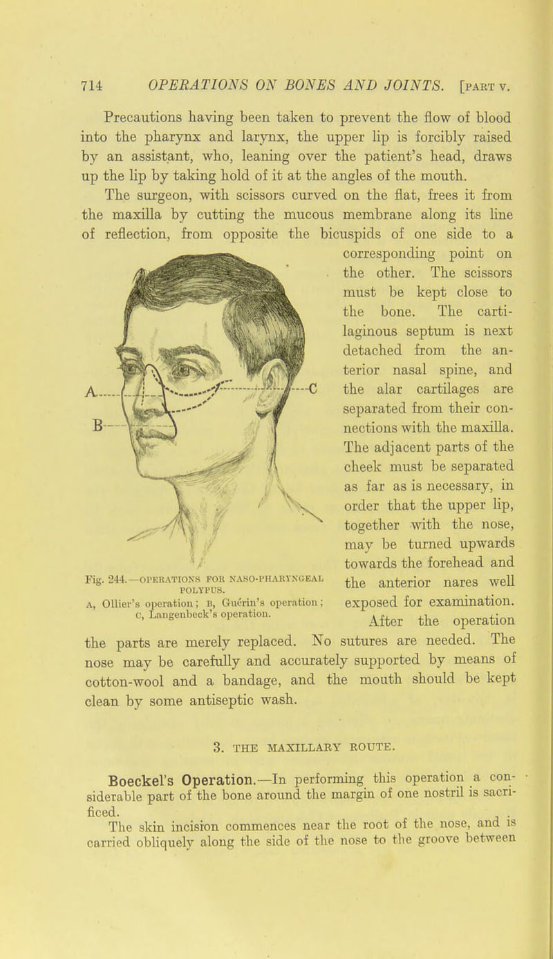 Precautions having been taken to prevent the flow of blood into the pharynx and larynx, the upper lip is forcibly raised by an assistant, who, leaning over the patient's head, draws up the lip by taking hold of it at the angles of the mouth. The surgeon, with scissors curved on the flat, frees it from the maxilla by cutting the mucous membrane along its line of reflection, from opposite the bicuspids of one side to a corresponding point on the other. The scissors must be kept close to the bone. The carti- laginous septum is next detached from the an- terior nasal spine, and the alar cartilages are separated from their con- nections with the maxilla. The adjacent parts of the cheek must be separated as far as is necessary, in order that the upper lip, together with the nose, may be turned upwards towards the forehead and B Fig. 244. -OPERATIONS FOR NASO-PHARYNGEAL POLYPUS. A, Ollier's operation; B, Guerin's operation ; C, Langenbeck's operation. the anterior nares well exposed for examination. After the operation the parts are merely replaced. No sutures are needed. The nose may be carefully and accurately supported by means of cotton-wool and a bandage, and the mouth should be kept clean by some antiseptic wash. 3. THE MAXILLARY ROUTE. Boeckel's Operation.—In performing this operation a con- siderable part of the bone around the margin of one nostril is sacri- ficed. The skin incision commences near the root of the nose, and is carried obliquely along the side of the nose to the groove between