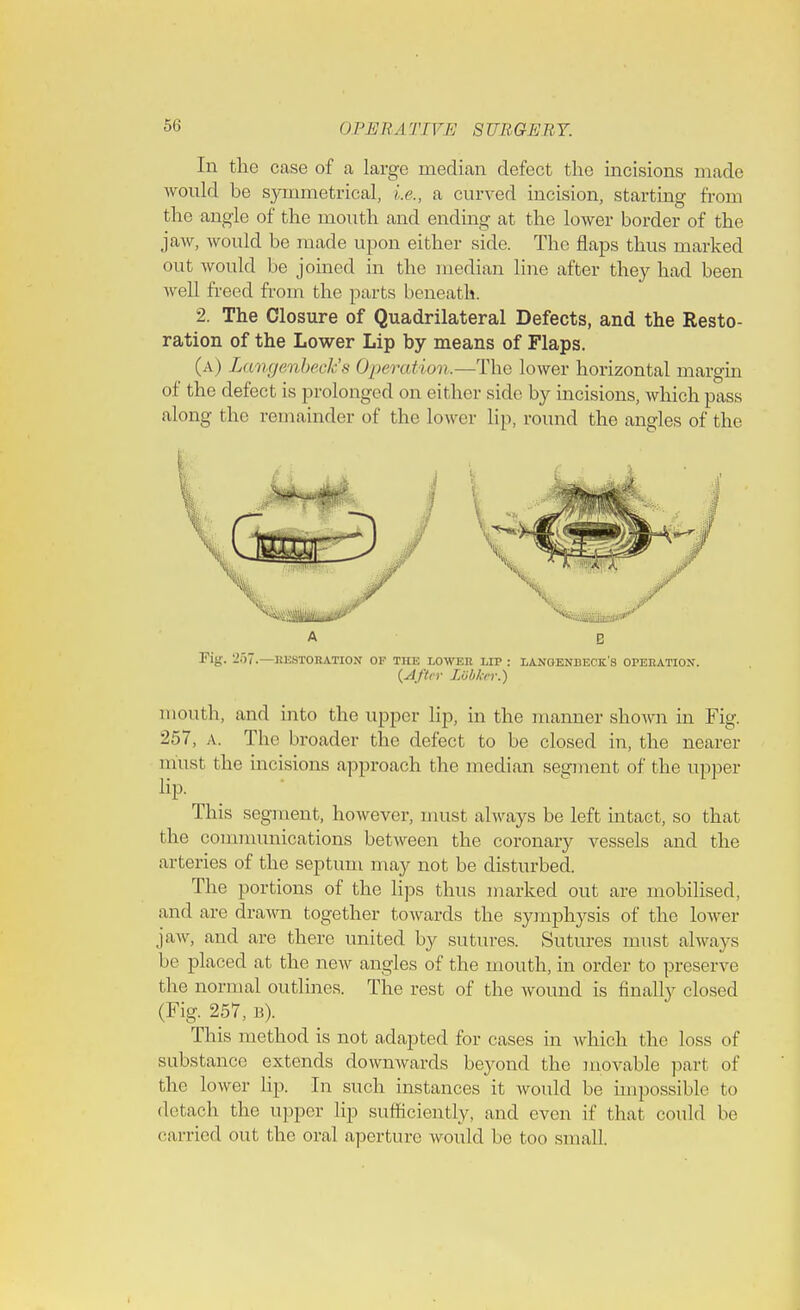 In the case of a large median defect the incisions made would be symmetrical, i.e., a curved incision, starting from the angle of the mouth and ending at the lower border of the jaw, would be made upon either side. The flaps thus marked out would be joined in the median line after they had been well freed from the parts beneath. 2. The Closure of Quadrilateral Defects, and the Resto- ration of the Lower Lip by means of Flaps. (a) Lcmgenbeck's Operation.—The lower horizontal margin of the defect is prolonged on either side by incisions, which pass along the remainder of the lower lip, round the angles of the Fiy. -')7. RESTORATION OF THE LOWER LIP : LANOENBECK'S OPERATION. {After Lobker.) mouth, and into the upper lip, in the manner shown in Fig. 257, A. The broader the defect to be closed in, the nearer must the incisions approach the median segment of the upper lip. This segment, however, must always be left intact, so that the communications between the coronary vessels and the arteries of the septum may not be disturbed. The portions of the lips thus marked out are mobilised, and are drawn together towards the symphysis of the lower jaw, and are there united by sutures. Sutures must always be placed at the new angles of the mouth, in order to preserve the normal outlines. The rest of the wound is finally closed (Fig. 257, b). This method is not adapted for cases in which the loss of substance extends downwards beyond the movable part of the lower hp. In such instances it would be impossible to detach the upper lip sufficiently, and even if that could be carried out the oral aperture would be too small.