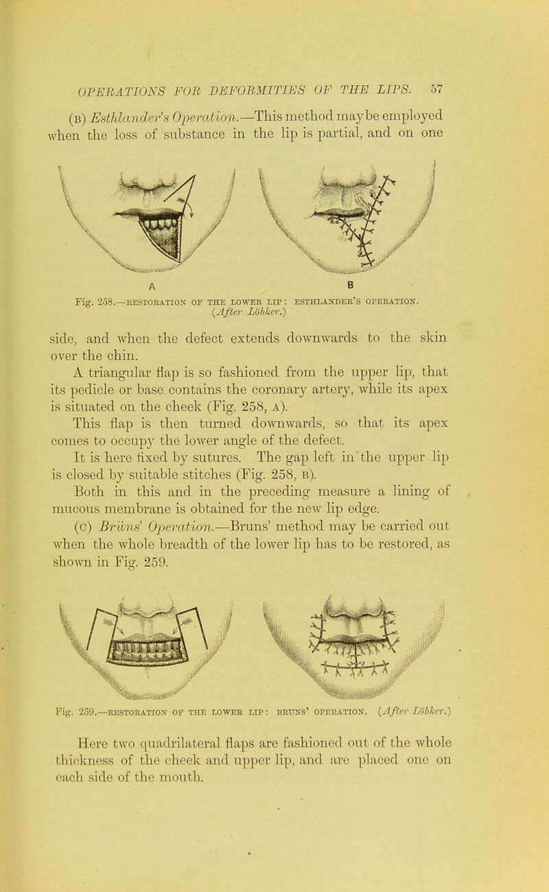 (b) Esthlander's Operation.—This method maybe employed when the loss of substance in the lip is partial, and on one a b Fig. 258.—RESTORATION OF THE LOWER LIP : ESTHLANDER'S OPERATION. (After Lohlter.) side, and when the defect extends downwards to the skin over the chin. A triangular flap is so fashioned from the upper hp, that its pedicle or base contains the coronary artery, while its apex is situated on the cheek (Fig. 258, a). This flap is then turned downwards, so that its apex comes to occupy the lower angle of the defect. It is here fixed by sutures. The gap left in the upper lip is closed by suitable stitches (Fig. 258, b). Both in this and in the preceding measure a lining of mucous membrane is obtained for the new lip edge. (c) Brims' Operation.—Bruns' method may be carried out when the whole breadth of the lower lip has to be restored, as shown in Fig. 259. Fig. 259.—RESTORATION OF THE LOWER LIP: BRUNS' OPERATION. (After I.obkcV.) Hove two quadrilateral flaps are fashioned out of the whole thickness of the cheek and upper lip, and are placed one on each side of the mouth.