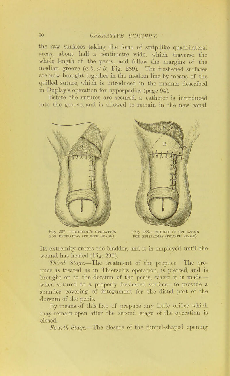 the raw surfaces taking the form of strip-like quadrilateral areas, about half a centimetre wide, which traverse the whole length of the penis, and follow the margins of the median groove (a b, a' b', Fig. 289). The freshened surfaces are now brought together in the median line by means of the (pulled suture, which is introduced in the manner described in Duplay's operation for hypospadias (page 94). Before the sutures are secured, a catheter is introduced into the groove, and is allowed to remain in the new canal. Fig. 287.—Thiersch's operation Fig. 288.—Thiersch's operation FOR EPISPADIAS (FOURTH STAGE). FOR EPISPADIAS (FOURTH STAQE). Its extremity enters the bladder, and it is employed until the wound has healed (Fig. 290). Tlii nl Stage,—The treatment of the prepuce. The pre- puce is treated as in Thiersch's operation, is pierced, and is brought on to the dorsum of the' penis, Avhere it is made— when sutured to a property freshened surface—to provide a sounder covering of integument for the distal part of the dorsum of the penis. By means of this flap of prepuce any little orifice which may remain open after the second stage of the operation is •closed. Fourth Stage.—The closure of the funnel-shaped opening