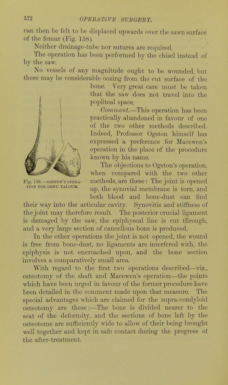can then be felt to be displaced upwards over the sawn surface of the femur (Fig. 158). Neither drainage-tube nor sutures are required. The operation has been performed by the chisel instead of by the saw. No vessels of any magnitude ought to be wounded, but there may be considerable oozing from the cut surface of the bone. Very great care must be taken that the saw does not travel into the poj)liteal space. Comment.—This operation has been practically abandoned in favour of one of the two other methods described. Indeed, Professor Ogston himself has expressed a preference for Macewen's operation in the place of the procedure known by his name. The objections to Ogston's operation, when compared with the two other methods, are these: The joint is opened up, the synovial membrane is torn, and both blood and bone-dust can find their way into the articular cavity. Synovitis and stiffness of the joint may therefore result. The posterior crucial ligament is damaged by the saw, the epiphyseal line is cut through, and a very large section of cancellous bone is produced. In the other operations the joint is not opened, the wound is free from bone-dust, no ligaments are interfered with, the epiphysis is not encroached upon, and the bone section involves a comparatively small area. With regard to the first tAvo operations described—viz., osteotomy of the shaft and Macewen's operation—the points which have been urged in favour of the former procedure have been detailed in the comment made upon that measure. The special advantages which are claimed for the supra-condyloid osteotomy are these:—The bone is divided nearer to the seat of the deformity, and the sections of bone left by the osteotome are sufficiently wide to allow of their being brought well together and kept in safe contact during the progress ot the after-treatment. Fig. 158.—ogston's OPERA- TION FOE GENU VALGUM.