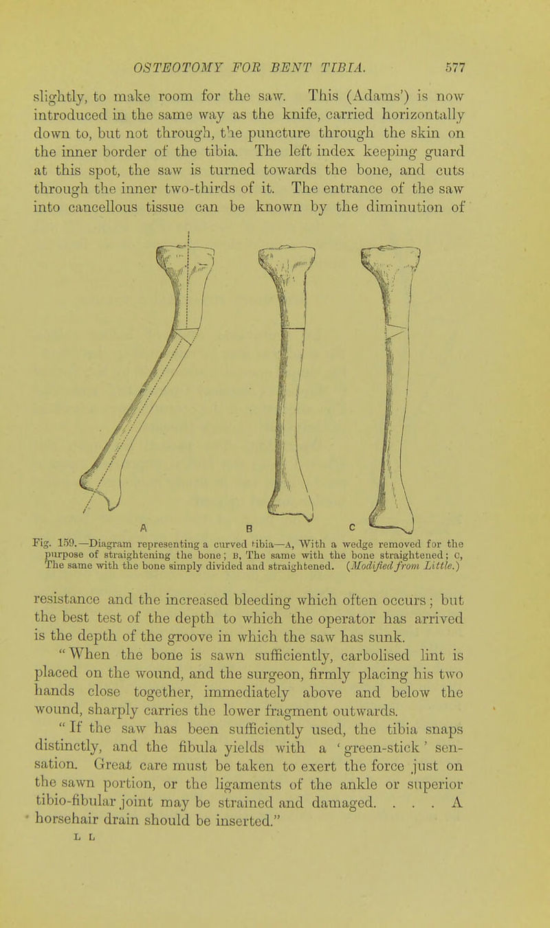 slightly, to make room for the saw. This (Adams') is now introduced in the same way as the knife, carried horizontally down to, but not through, the puncture through the skin on the inner border of the tibia. The left index keepuig guard at this spot, the saw is turned towards the bone, and cuts through the inner two-thirds of it. The entrance of the saw into cancellous tissue can be known by the diminution of Fig. 159.—Diagram representing a curved fibia—A, With a wedge removed far the purpose of straightening the bone; B, The same with the bone straightened; C, The same with the bone simply divided and straightened. {Modifiedfrom Little.) resistance and the increased bleeding which often occurs; but the best test of the depth to which the operator has arrived is the depth of the groove in which the saw has sunk. When the bone is sawn sufficiently, carbolised lint is placed on the wound, and the surgeon, firmly placing his two hands close together, immediately above and below the wound, sharply carries the lower fragment outwards. If the saw has been sufficiently used, the tibia snaps distinctly, and the fibula yields with a ' green-stick' sen- sation. Great care must be taken to exert the force just on the sawn portion, or the ligaments of the ankle or superior tibio-fibular joint maybe strained and damaged. ... A • horsehair drain should be inserted. L L