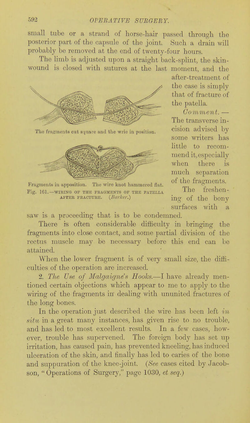 •''>92 OFEBATIVE SURGERY. small tube or a strand of horse-hair passed through the posterior part of the capsule of the joint. Such a drain will probably be removed at the end of twenty-four hours. The limb is adjusted upon a straight back-splint, the skin- wound is closed with sutures at the last moment, and the after-treatment of the case is simply that of fracture of the patella. Comment. — The transverse in- cision advised by some writers has Httle to recom- mend it, especially when there is much separation of the fragments. The freshen- ing of the bony surfaces with a saw is a proceeding that is to be condemned. There is often considerable difficulty in bringing the fragments into close contact, and some partial division of the rectus muscle may be necessary before this end can be attained. When the lower fragment is of very small size, the diffi- culties of the operation are incresised. 2. The Use of Malgaigne's Hooks.—I have already men- tioned certain objections which appear to me to apply to the wiring of the fragments in dealing with ununited fractures of the long bones. In the operation just described the wire has been left in situ in a great many instances, has given rise to no trouble, and has led to most excellent results. In a few cases, how- ever, trouble has supervened. The foreign body has set up irritation, has caused pain, has prevented kneeling, has induced ulceration of the skin, and finally has led to caries of the bone and suppuration of the knee-joint. {See cases cited by Jacob- son,  Operations of Surgery, page 1030, et seq.) The fragments cut square and the wrie in position. Fragments in apposition. The wire knot hammered flat. Fig. 161.—WIRINa OF THE FRAGMENTS OF THE PATELLA AFTEE FEACTtniE. {Jllir/c(tr.)