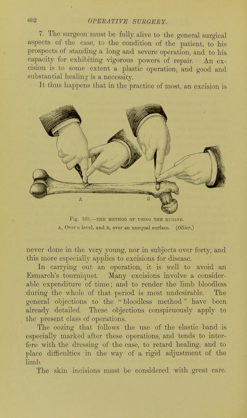 I «02 OPERATIVE SURGE BY. 7. The surgeon must be fully alive to the general surgical aspects of the case, to the condition of the patient, to his prospects of standing a long and severe operation, and to his capacity for exhibiting vigorous powers of repair. An ex- cision is to some extent a plastic operation, and good and substantial healing is a necessity. It thus happens that in the practice of most, an excision is Fig. 169.—THE METHOD OF USING THE BUGINE. A, Over a level, and B, over an unequal surface. (Oilier.) never done in the very young, nor in subjects over forty, and this more especially applies to excisions for disease. In carrying out an operation, it is well to avoid an Esmarch's tourniquet. Many excisions involve a consider- able expenditure of time; and to render the limb bloodless during the Avhole of that period is most undesirable. The general objections to the  bloodless method have been already detailed. These objections conspicuously apply to the present class of operations. The oozing that follows the use of the elastic band is especially marked after these oj)erations, and tends to inter- fere with the dressing of the case, to retard healing, and to place difficulties in the way of a rigid adjustment of the limb. The skin incisions must be considered with gi*eat care.