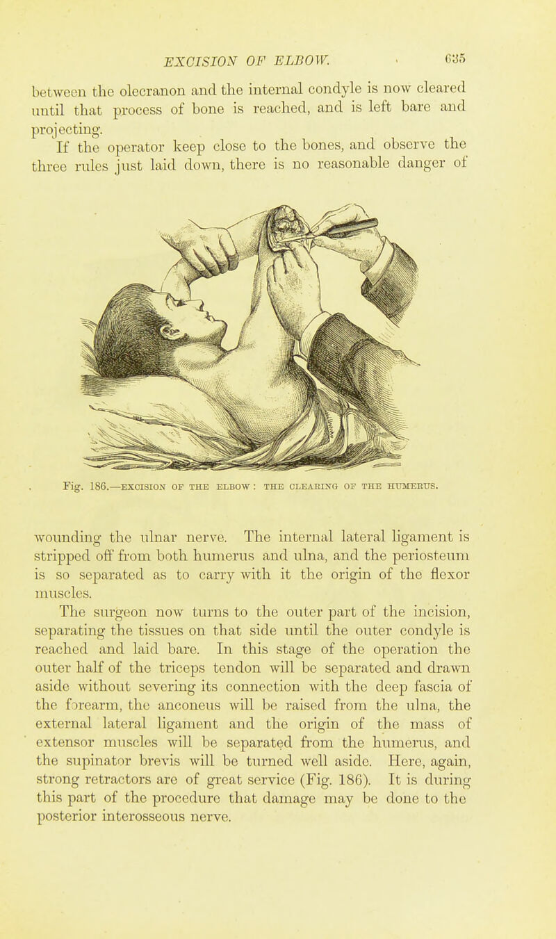 between the olecranon and the internal condyle is now cleared until that process of bone is reached, and is left bare and projecting. If the operator keep close to the bones, and observe the three rules just laid down, there is no reasonable danger of Fig. 186.—EXCISION OF THE ELBOW : THE CLEAEING OF THE HTJMEEUS. wounding the ulnar nerve. The internal lateral ligament is stripped off' from both humerus and ulna, and the periosteum is so separated as to carry with it the origin of the flexor muscles. The surgeon now turns to the outer part of the incision, separating the tissues on that side until the outer condyle is reached and laid bare. In this stage of the operation the outer half of the triceps tendon will be separated and drawn aside without severing its connection with the deep fascia of the forearm, the anconeus will be raised from the ulna, the external lateral ligament and the origin of the mass of extensor muscles will be separated from the humerus, and the supinator brevis will be turned well aside. Here, again, strong retractors are of great service (Fig. 186). It is during this part of the procedure that damage may be done to the posterior interosseous nerve.
