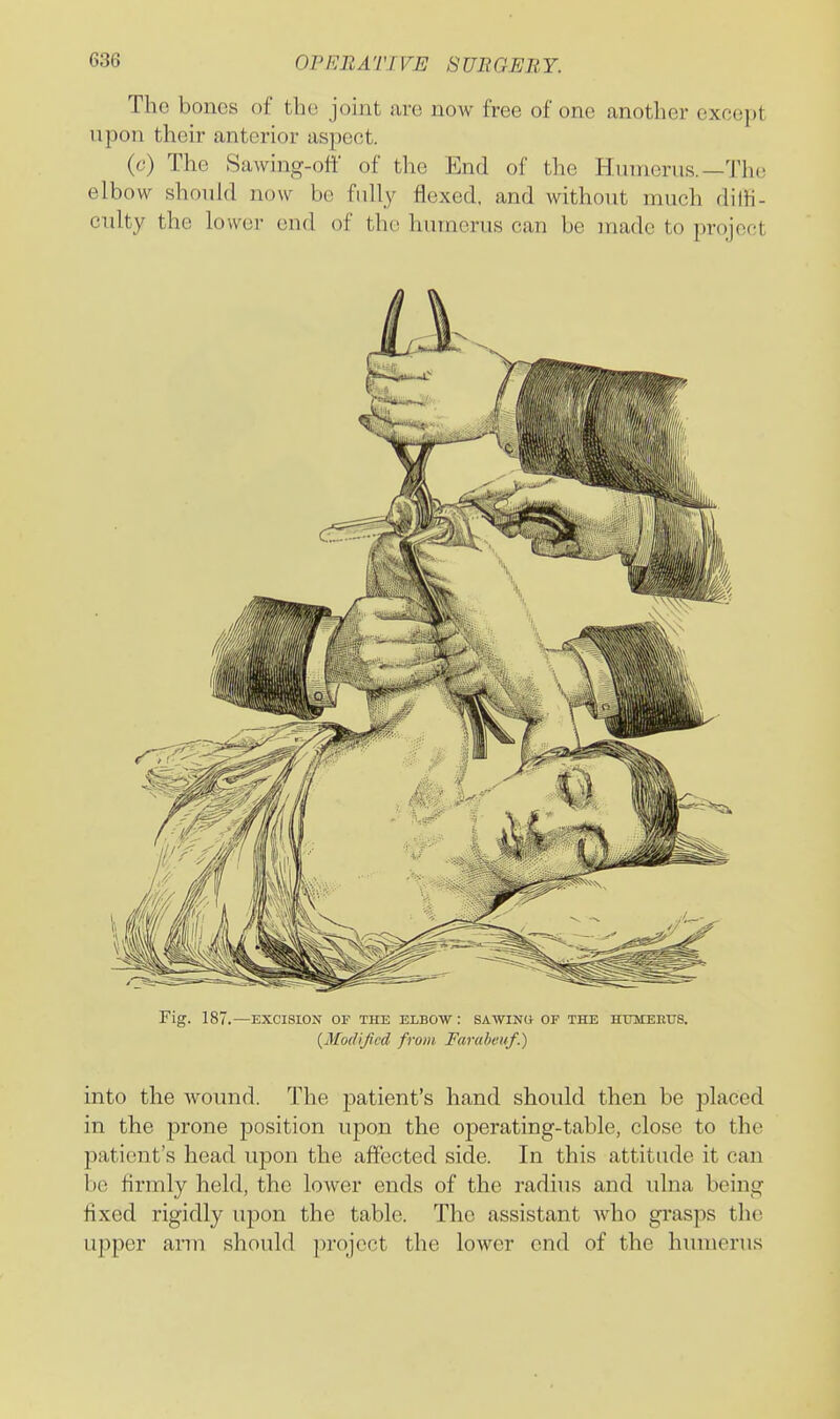 The bones of the joint iiro now free of one another except upon their anterior aspect. (c) The Sawing-off of the End of the Hinnerus.—Th(! elbow should now be fully flexed, and without much dilH- culty the lower end of the humerus can be made to project Fig. 187.—EXCISION OF THE ELBOW: SAWING OF THE HXJMEEUS. [MoiUficd from Farubeuf.) into the wound. The patient's hand should then be placed in the prone position upon the operating-table, close to the patient's head upon the affected side. In this attitude it can be firmly held, the lower ends of the radius and ulna being fixed rigidly upon the table. The assistant who grasps the upper arm should project the lower end of the humerus