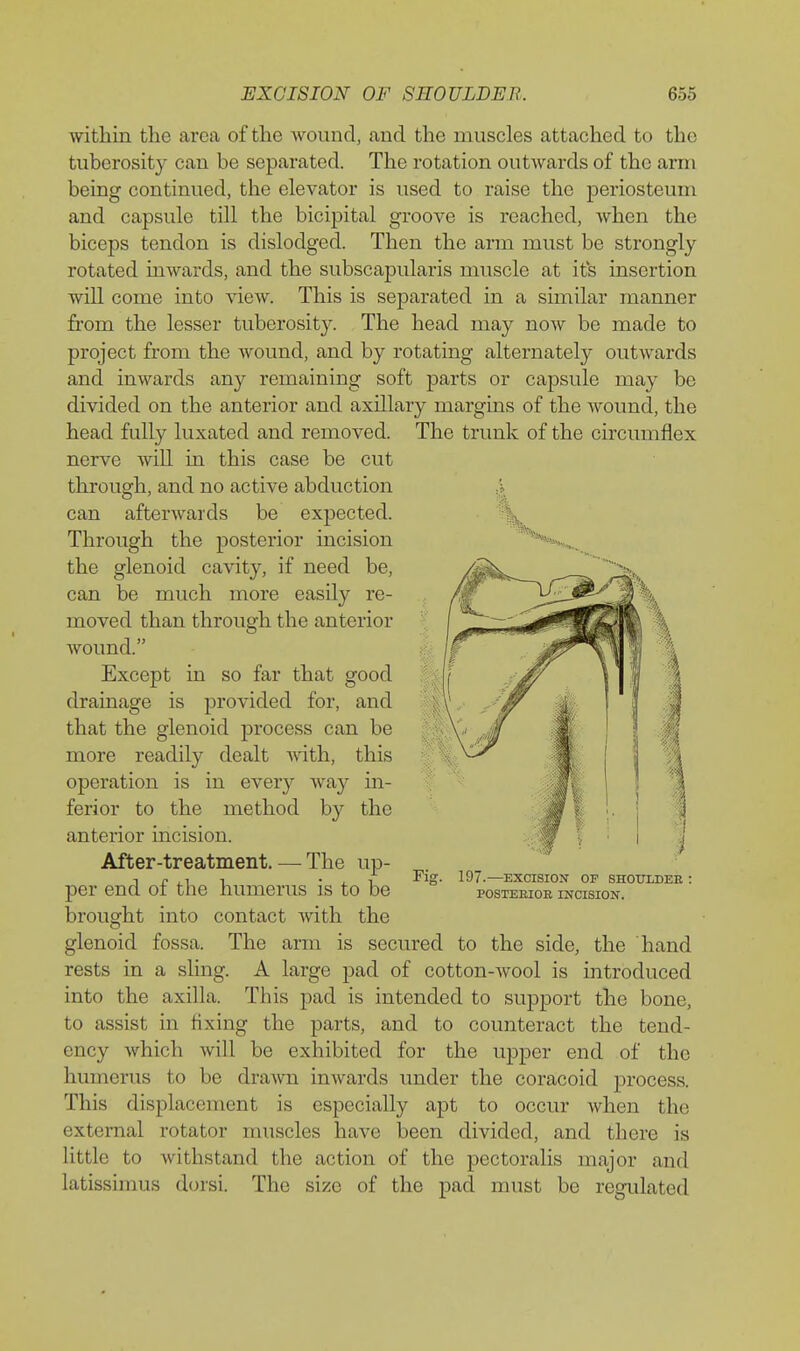 within the area of the wound, and the muscles attached to the tuberosity can be separated. The rotation outwards of the arm being continued, the elevator is used to raise the periosteum and capsule till the bicipital groove is reached, when the biceps tendon is dislodged. Then the arm must be strongly rotated inwards, and the subscapularis muscle at its insertion will come into view. This is separated in a similar manner from the lesser tuberosity. The head may now be made to project from the wound, and by rotating alternately outwards and inwards any remaining soft parts or capsule may be divided on the anterior and axillary margins of the wound, the head fully luxated and removed. The trunk of the circumflex nerve will in this case be cut through, and no active abduction .5. can afterwards be expected. Through the posterior incision '^^^'^.^ the glenoid cavity, if need be, can be much more easily re- moved than through the anterior wound. Except in so far that good drainage is provided for, and that the glenoid process can be more readily dealt with, this operation is in every way in- ferior to the method by the anterior incision. After-treatment. — The up- per end of the humerus is to be brought into contact with the glenoid fossa. The arm is secured to the side, the hand rests in a sling. A large pad of cotton-wool is introduced into the axilla. This pad is intended to support the bone, to assist in fixing the parts, and to counteract the tend- ency which will be exhibited for the upper end of the humerus to be drawn inwards under the coracoid process. This displacement is especially apt to occur when the external rotator muscles have been divided, and there is little to withstand the action of the pectoralis major and latissimus dorsi. The size of the pad must be regulated Fig. 197.—EXCISION OF SHOULDEE : POSTEEIOB INCISION.