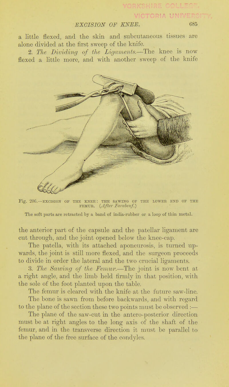 a little flexed, and the skin and subcutaneous tissues are alone divided at the first sweep of the knife. 2. The Dividing of the Ligaments.—The knee is now flexed a little more, and with another sweep of the knife Fig. 206.—EXCISION OF the knee : the sawing or the lowed, end of the FEMUE. {After Farabcvf.) The soft parts are retracted by a band of india-rubber or a loop of thin metal. the anterior part of the capsule and the patellar ligament are cut through, and the joint opened beloAv the knee-cap. The patella, with its attached aponeurosis, is turned up- wards, the joint is still more flexed, and the surgeon proceeds to divide in order the lateral and the two crucial ligaments. 3. The Sawing of the Femur.—The joint is now bent at a right angle, and the limb held firmly in that position, Avith the sole of the foot planted upon the table. The femur is cleared with the knife at the future saAV-line. The bone is sawn from before backwards, and with regard to the plane of the section these two points must be observed :— The plane of the saw-cut in the antero-posterior direction nuTst be at right angles to the long axis of the shaft of the femur, and in the transverse direction it nmst be parallel to the plane of the free surface of the condyles.