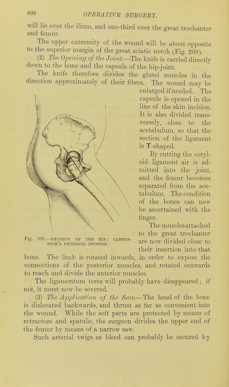 will lie over the ilium, and one-third over the great trochanter and femur. The upper extremity of the wound will be about opposite to the superior margin of the great sciatic notch (Fig. 209). (2) The Opening of the Joint—The knife is carried directly down to the bone and the capsule of the hip-joint. The knife therefore divides the glutei muscles in the direction approximately of their fibres. The wound may be enlarged if needed. The capsule is opened in the line of the skin incision. It is also divided trans- versel}^, close to the acetabulum, so that the section of the ligament is T-shaped. By cutting the cotyl- oid ligament air is ad- mitted into the joint, and the femur becomes separated from the ace- tabulum. The condition of the bones can now be ascertained with the hnger. The muscles attached to the great trochanter are now divided close to their insertion mto that bone. The limb is rotated inwards, in order to expose the connections of the posterior muscles, and rotated outwards to reach and divide the anterior muscles. The liganientum teres will probabl}^ have disappeared; if not, it must now be severed. (3) The A2')plication of the Saw.—The head of the bone is dislocated backwards, and thrust as far as convenient into the wound. While the soft parts are protected by means of retractors and spatulre, the surgeon divides the upper end of the femur by means of a narrow saw. Such arterial twigs as bleed can pj-obably be secured by Fig. 209.—EXCISION OF THE HIP: beck's EXTEENAl INCISION. LANOEN-