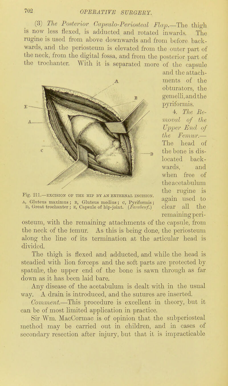 (3) The Posterior Capsulo-Periosteal FLa2).—The thigh is now less flexed, is adducted and rotated inwards. The rugine is used from above downwards and from before back- wards, and the periosteum is elevated from the outer part of the neck, from the digital fossa, and from the posterior part of the trochanter. With it is separated more of the capsule and the attach- ments of the obturators, the gemelli,andthe pyrifonnis. 4. The Re- moval of the Upper End of the Femwr.— The head of the bone is dis- located back- wards, and when free of the acetabulum the rugine is again used to clear all the remaming peri- osteum, with the remaining attachments of the capsule, from the neck of the femur. As this is being done, the periosteum along the line of its termination at the articular head is divided. The thigh is flexed and adducted, and while the head is steadied with lion forceps and the soft parts are protected by spatulae, the upper end of the bone is sawn through as far down as it has been laid bare. Any disease of the acetabulum is dealt with in the usual way. A drain is introduced, and the sutures are inserted. Comment.—This procedure is excellent in theory, but it can be of most limited application in practice. Sir Wm. MacCormac is of opinion that the subperiosteal method may be carried out in children, and in cases of secondary resection after injury, but that it is impracticable Fig. —EXCISION OF THE HIP BY AN EXTERNAL INCISION. A, Gluteus maximus ; B, Gluteus medius; c. Piriformis; D, Great trochanter; e. Capsule of hip-joint. [larabeiif.)