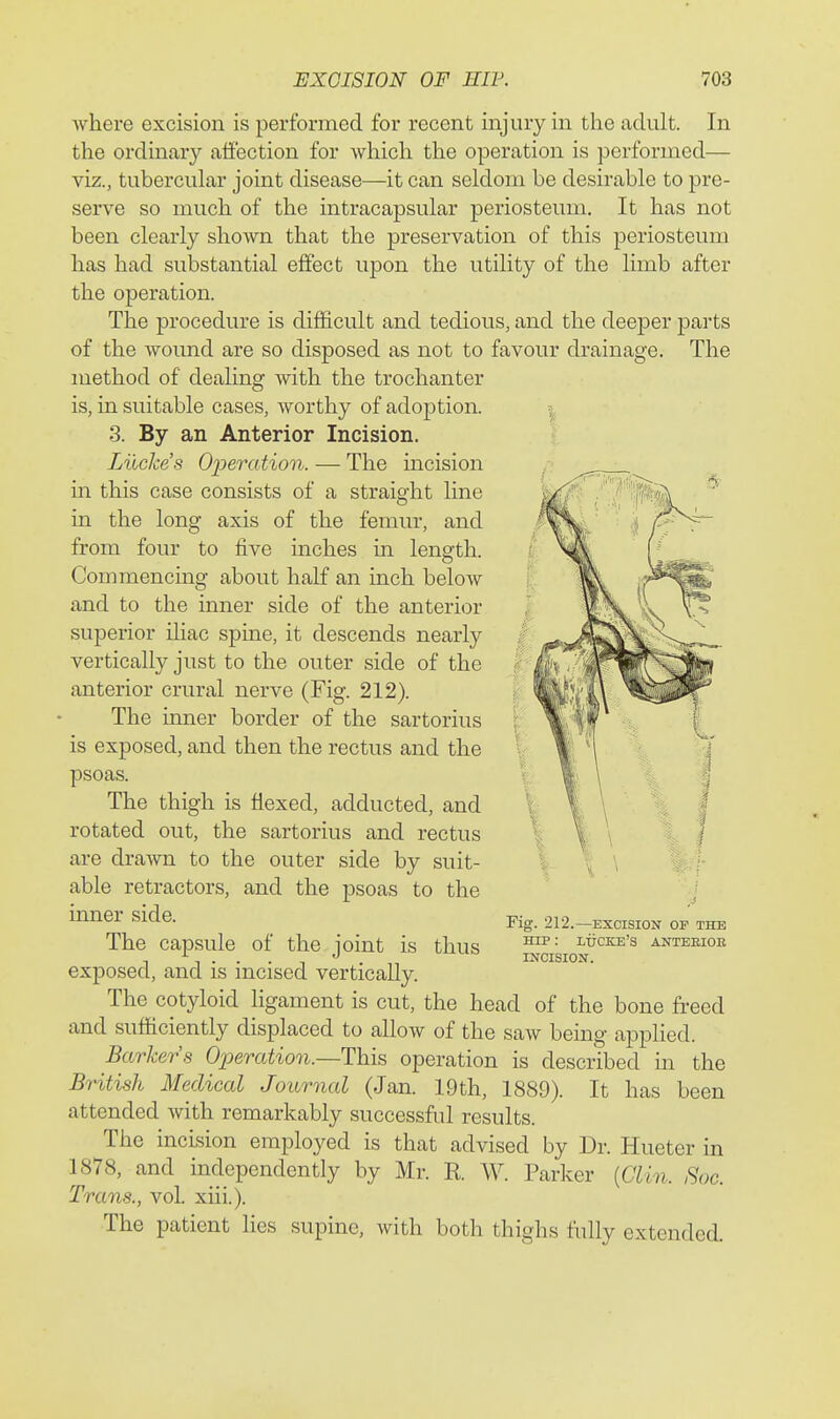 where excision is performed for recent injury in the adult. In the ordinary affection for which the operation is performed— viz., tubercular joint disease—it can seldom be desirable to pre- serve so much of the intracapsular periosteum. It has not been clearly shown that the preservation of this periosteum has had substantial effect upon the utility of the limb after the operation. The procedure is difficult and tedious, and the deeper parts of the wound are so disposed as not to favour drainage. The method of dealing with the trochanter is, in suitable cases, worthy of adoption. 3. By an Anterior Incision. Lucke's Operation. — The mcision in this case consists of a straight line in the long axis of the femur, and from four to five inches in length. Commencing about half an inch below and to the inner side of the anterior superior ihac spine, it descends nearly vertically just to the outer side of the anterior crural nerve (Fig. 212). The inner border of the sartorius is exposed, and then the rectus and the psoas. The thigh is flexed, adducted, and rotated out, the sartorius and rectus are drawn to the outer side by suit- able retractors, and the psoas to the mner side. Fig 212.—excision of the The capsule of the ioint is thus ^-^^cke's anteeioh , ^ . INCISION. exposed, and is mcised vertically. The cotyloid ligament is cut, the head of the bone freed and sufficiently displaced to allow of the saw being applied. Barkers Operation.—Thi?, operation is described in the British Medical Journal (Jan. 19th, 1889). It has been attended with remarkably successful results. The incision employed is that advised by Dr. Hueter in 1878, and independently by Mr. R W. Parker {Clin. Soc. Trans., vol. xiii.). The patient lies supine, with both thighs fully extended.