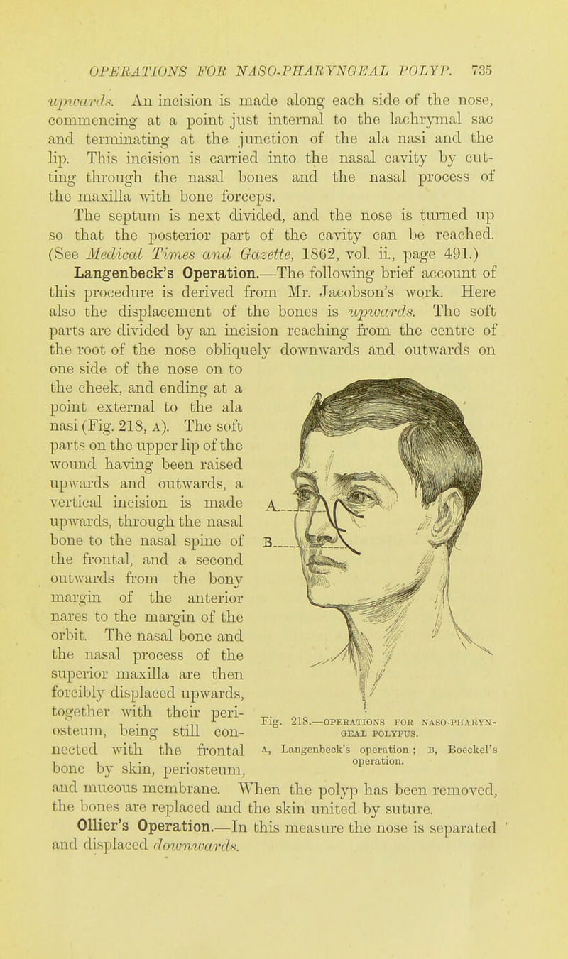 U2nvards. An incision is made along each side of the nose, commencing at a point just internal to the lachrymal sac and terminating at the junction of the ala nasi and the lip. This incision is carried into the nasal cavity by cut- ting through the nasal bones and the nasal process of the maxilla with bone forceps. The septum is next divided, and the nose is turned up so that the j)osterior part of the cavity can be reached. (See Medical Times and, Gazette, 1862, vol. ii., page 491.) Langenbeck's Operation.—The following brief account of this procedure is derived from Mr. Jacobson's work. Here also the displacement of the bones is upwards. The soft j)arts are divided by an incision reaching from the centre of the root of the nose obliquely downwards and outwards on one side of the nose on to the cheek, and ending at a point external to the ala nasi (Fig. 218, a). The soft parts on the upper lip of the wound having been raised upwards and outwards, a vertical incision is made upwards, through the nasal bone to the nasal spine of the frontal, and a second outwards fi-om the bonv margin of the anterior nares to the margin of the orbit. The nasal bone and the nasal process of the superior maxilla are then forcibly displaced upwards, together with their peri- osteum, being still con- nected with the frontal bone by skin, periosteum, and mucous membrane. When the polyp has been removed, the bones are replaced and the skin united by suture. Ollier's Operation.—In this measure the nose is separated and displaced doivnwards. rig. 218.—OPERATIONS FOR NASO-PHAEYN- GEAX POLYPUS. A, Langenbeck's operation ; B, Boeckel's operation.