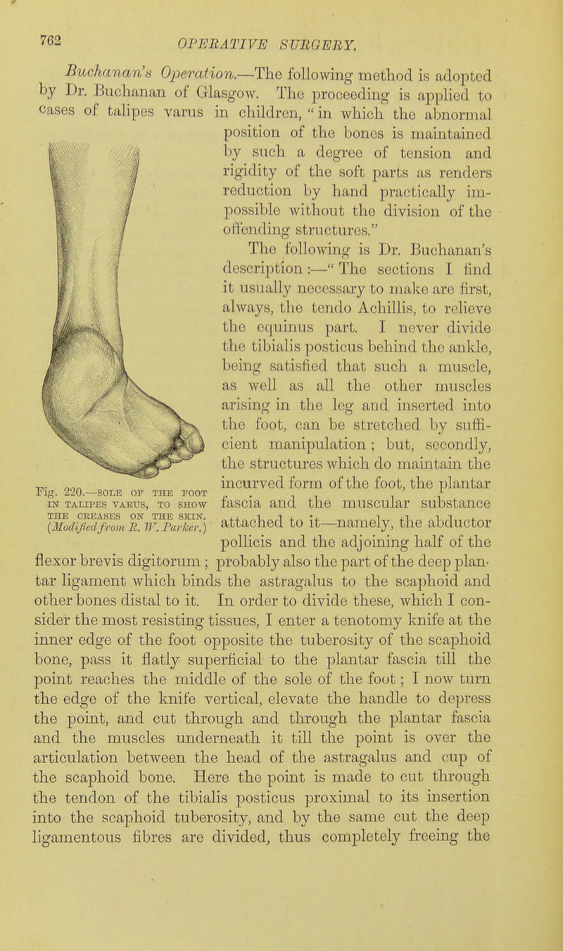 Buchavan's Operation.—The following method is adopted by Dr. Buchanan of Glasgow. The proceeding is applied to Cases of talipes varus in children,  in which the abnormal position of the bones is maintained by such a degree of tension and rigidity of the soft parts as renders reduction by hand practically nu- possible without the division of the offending structures. The following is Dr. Buchanan's description :— The sections I find it usually necessary to make are first, always, the tendo Achillis, to reheve the equinus part. I never divide the tibialis posticus behind the ankle, being satisfied that such a muscle, as well as all the other muscles arising in the leg and inserted into the foot, can be stretched by suffi- cient manipulation ; but, secondly, the structures which do maintain the incurved form of the foot, the plantar fascia and the muscular substance attached to it—namely, the abductor pollicis and the adjoining half of the flexor brevis digitorum ; probably also the part of the deep plan- tar ligament which binds the astragalus to the scaphoid and other bones distal to it. In order to divide these, which I con- sider the most resisting tissues, I enter a tenotomy knife at the inner edge of the foot opposite the tuberosity of the scaphoid bone, pass it flatly superficial to the plantar fascia till the point reaches the middle of the sole of the foot; I now turn the edge of the knife vertical, elevate the handle to depress the point, and cut through and through the plantar fascia and the muscles underneath it till the point is over the articulation between the head of the astragalus and cup of the scaphoid bone. Here the point is made to cut through the tendon of the tibialis posticus proximal to its insertion into the scaphoid tuberosity, and by the same cut the deep ligamentous fibres are divided, thus completely freeing the Fig. 220.—SOLE OF THE FOOT IN TALIPES VAEUS, TO SHOW THE CBEASES ON THE SKIN. {Modijivdfrom li. IF. Farkcr.)