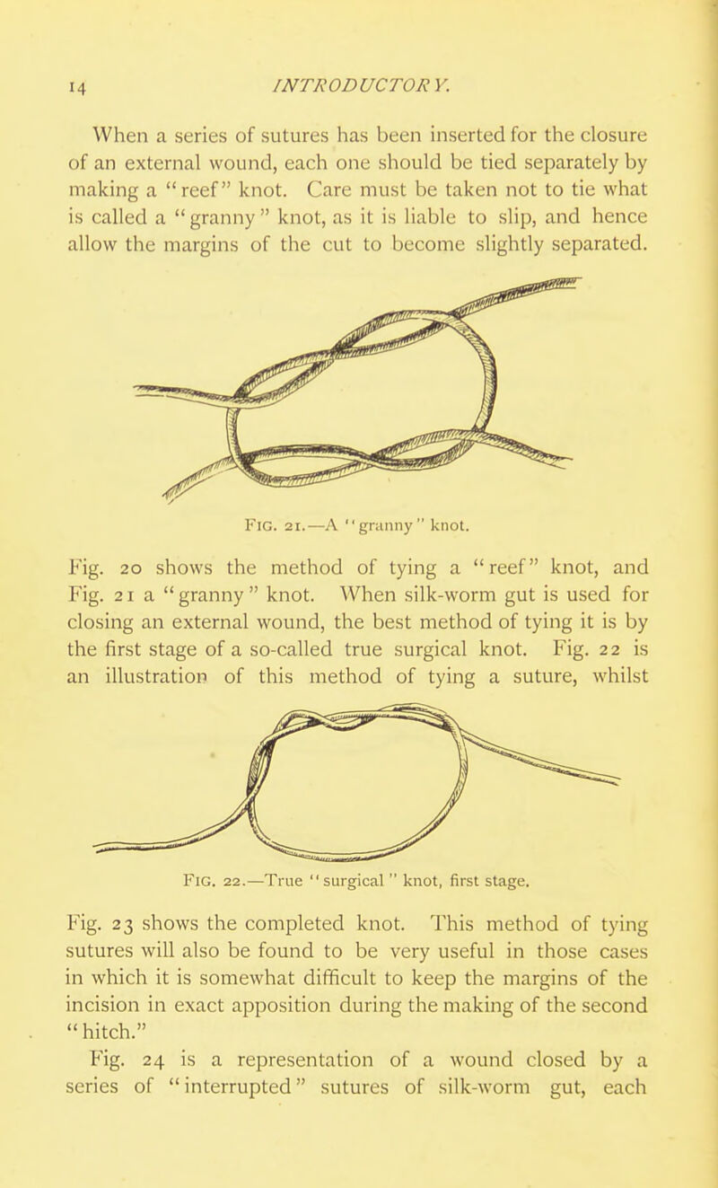 When a series of sutures has been inserted for the closure of an external wound, each one should be tied separately by making a reef knot. Care must be taken not to tie what is called a  granny  knot, as it is liable to slip, and hence allow the margins of the cut to become slightly separated. Fig. 21.—A granny knot. Fig. 20 shows the method of tying a reef knot, and Fig. 21 a  granny  knot. When silk-worm gut is used for closing an external wound, the best method of tying it is by the first stage of a so-called true surgical knot. Fig. 22 is an illustration of this method of tying a suture, whilst Fig. 22.—TiLie surgical  knot, first stage. Fig. 23 shows the completed knot. This method of tying sutures will also be found to be very useful in those cases in which it is somewhat difficult to keep the margins of the incision in exact apposition during the making of the second hitch. Fig. 24 is a representation of a wound closed by a series of  interrupted sutures of silk-worm gut, each