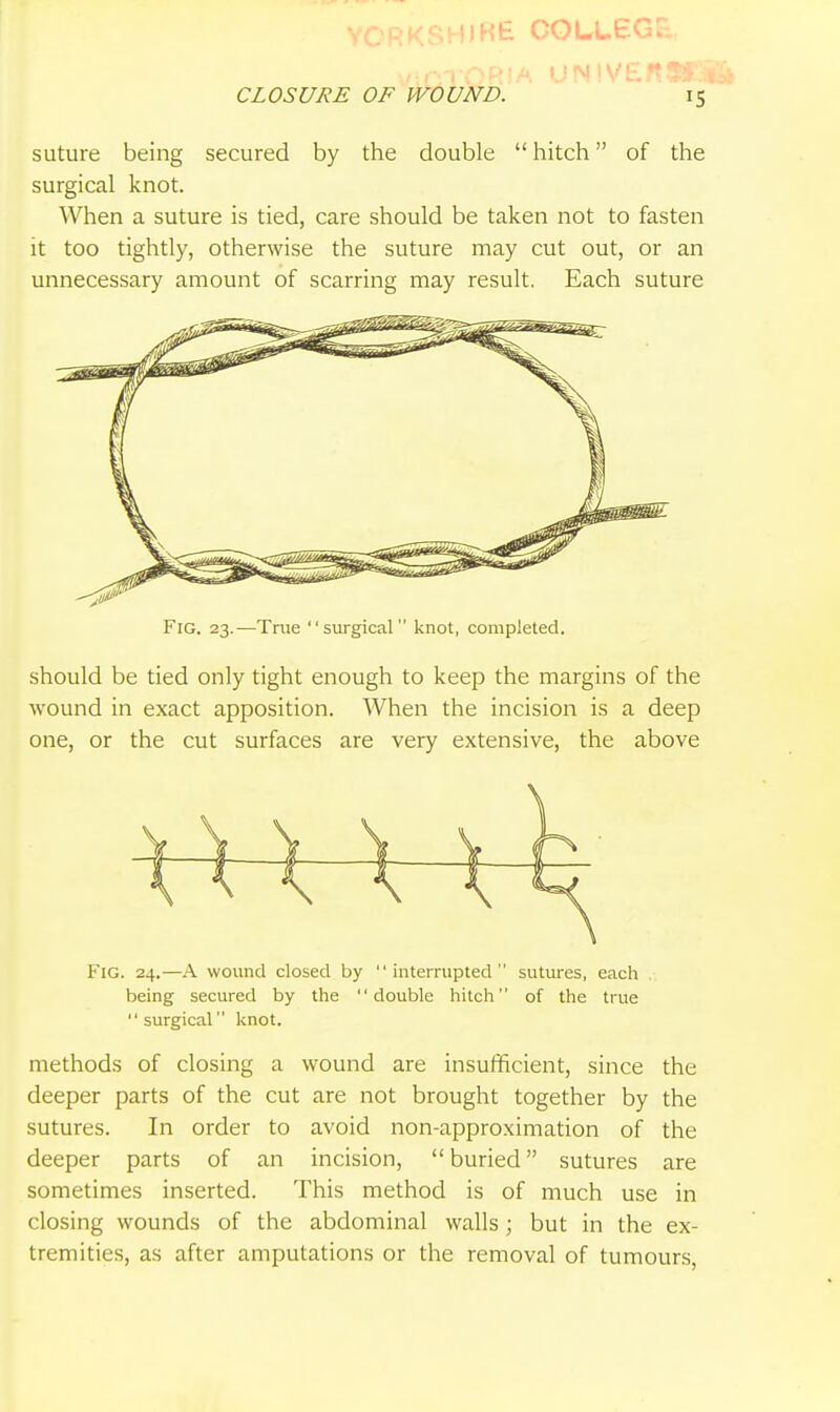 COLLECr CLOSURE OF WOUND. 15 suture being secured by the double  hitch of the surgical knot. When a suture is tied, care should be taken not to fasten it too tightly, otherwise the suture may cut out, or an unnecessary amount of scarring may result. Each suture Fig. 23.—True surgical knot, completed. should be tied only tight enough to keep the margins of the wound in exact apposition. When the incision is a deep one, or the cut surfaces are very extensive, the above Fig. 24.—A wound closed by interrupted sutures, each being secured by the double hitch of the true  surgical knot. methods of closing a wound are insufficient, since the deeper parts of the cut are not brought together by the sutures. In order to avoid non-approximation of the deeper parts of an incision, buried sutures are sometimes inserted. This method is of much use in closing wounds of the abdominal walls; but in the ex- tremities, as after amputations or the removal of tumours.