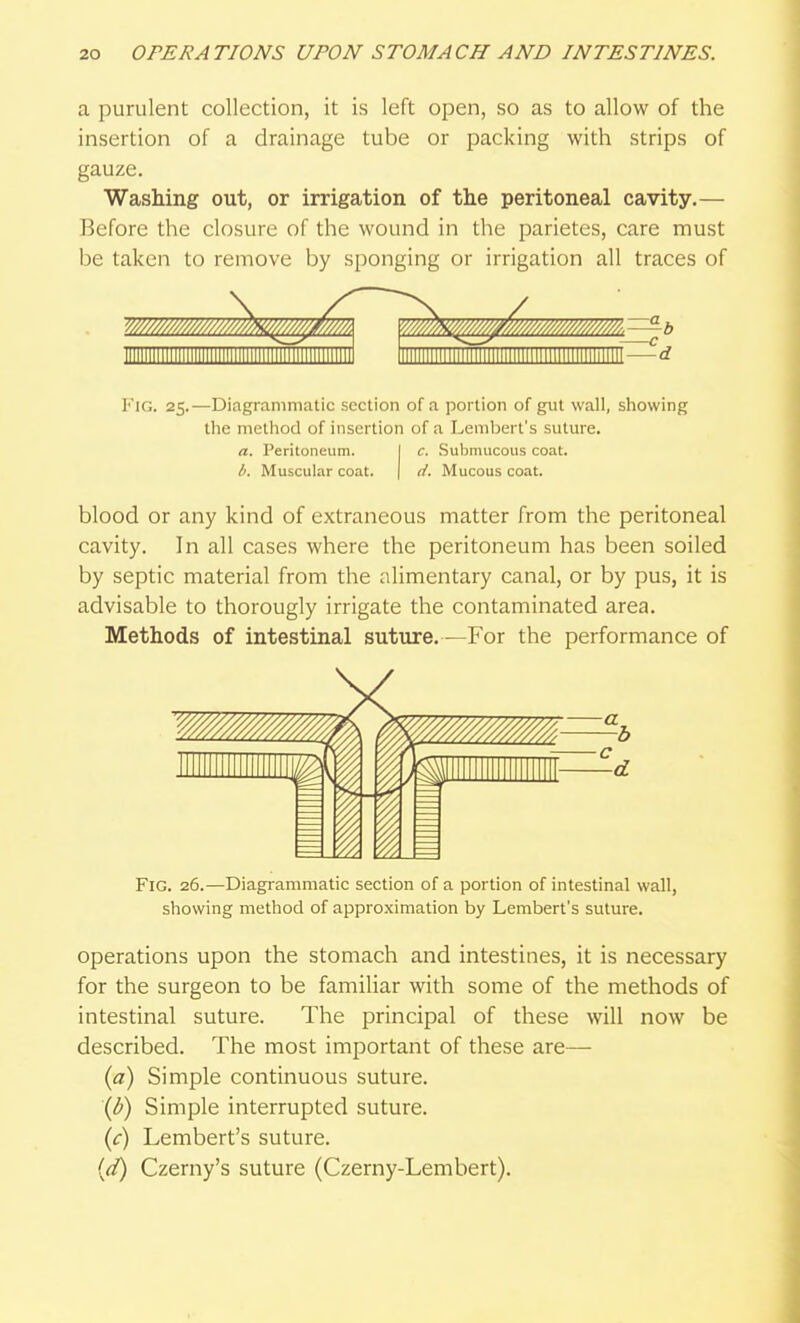 a purulent collection, it is left open, so as to allow of the insertion of a drainage tube or packing with strips of gauze. Washing out, or irrigation of the peritoneal cavity.— Before the closure of the wound in the parietes, care must be taken to remove by sponging or irrigation all traces of l''iG. 25.—Diagrammatic section of a portion of gut wall, showing the method of insertion of a Lembei t's suture. a. Peritoneum. I c. Submucous coat. Muscular coat. | d. Mucous coat. blood or any kind of extraneous matter from the peritoneal cavity. In all cases where the peritoneum has been soiled by septic material from the alimentary canal, or by pus, it is advisable to thorougly irrigate the contaminated area. Methods of intestinal suture.—For the performance of Fig. 26.—Diagrammatic section of a portion of intestinal wall, showing method of approximation by Lembert's suture. operations upon the stomach and intestines, it is necessary for the surgeon to be familiar with some of the methods of intestinal suture. The principal of these will now be described. The most important of these are— {a) Simple continuous suture. \b) Simple interrupted suture. {c) Lembert's suture. {d) Czerny's suture (Czerny-Lembert).