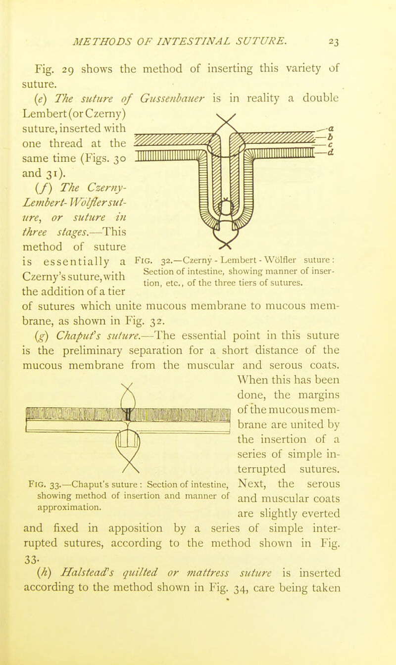 Fig. 32.—Czerny - Lembert - Wolfler suture : Section of intestine, showing manner of inser- tion, etc., of the three tiers of sutures. Fig. 29 shows the method of inserting this variety of suture. {e) The suture of Gussenbauer is in reality a double Lembert (or Czerny) suture, inserted with one thread at the same time (Figs. 30 and 31). (/) The Czerny- Lembert- Wolfler sut- ure, or suture in three stages.—This method of suture is essentially a Czerny's suture, with the addition of a tier of sutures which unite mucous membrane to mucous mem- brane, as shown in Fig. 32. {g) Chapufs suture.—The essential point in this suture is the preliminary separation for a short distance of the mucous membrane from the muscular and serous coats. When this has been done, the margins of the mucous mem- brane are united by the insertion of a series of simple in- terrupted sutures. Next, the serous and muscular coats are slightly everted series of simple inter- in Fig. Fig. 33.—Chaput's suture : Section of intestine, showing method of insertion and manner of approximation. and fixed in apposition by a rupted sutures, according to the method shown 33- (//) Halstead's quilted or mattress suture is inserted according to the method shown in Fig. 34, care being taken