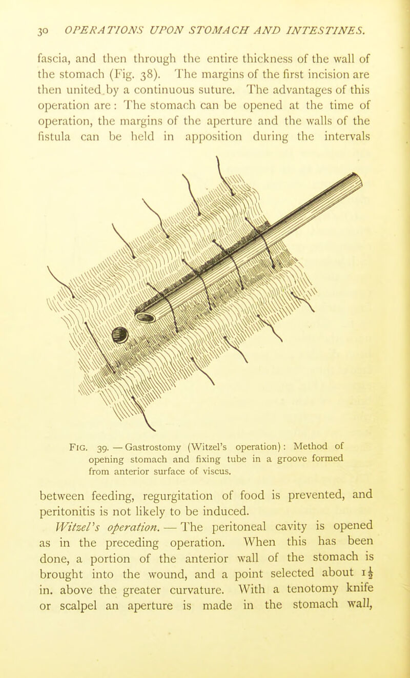fascia, and then through the entire thickness of the wall of the stomach (Fig. 38). The margins of the first incision are then united.by a continuous suture. The advantages of this operation are: The stomach can be opened at the time of operation, the margins of the aperture and the walls of the fistula can be held in apposition during the intervals Fig. 39.—Gastrostomy (Witzel's operation): Method of opening stomach and fixing tube in a groove formed from anterior surface of viscus. between feeding, regurgitation of food is prevented, and peritonitis is not likely to be induced. WitzePs operation. — The peritoneal cavity is opened as in the preceding operation. When this has been done, a portion of the anterior wall of the stomach is brought into the wound, and a point selected about in. above the greater curvature. With a tenotomy knife or scalpel an aperture is made in the stomach wall,