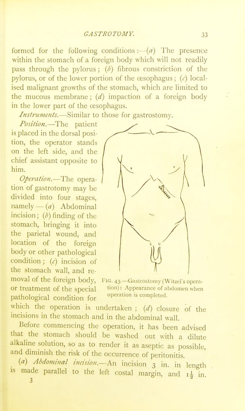 formed for the following conditions :—{a) The presence within the stomach of a foreign body which will not readily pass through the pylorus; (J)) fibrous constriction of the pylorus, or of the lower portion of the oesophagus ; {c) local- ised malignant growths of the stomach, which are limited to the mucous membrane; {d) impaction of a foreign body in the lower part of the oesophagus. Instru7)ients.—Similar to those for gastrostomy. Position.—The patient is placed in the dorsal posi- tion, the operator stands on the left side, and the chief assistant opposite to him. Operation.—The opera- tion of gastrotomy may be divided into four stages, namely — {a) Abdominal incision; (/;) finding of the stomach, bringing it into the parietal wound, and location of the foreign body or other pathological condition; {c) incision of the stomach wall, and re- moval of the foreign bod)', or treatment of the special pathological condition for which the operation is undertaken ; {d) closure of the incisions in the stomach and in the abdominal wall. Before commencing the operation, it has been advised that the stomach should be washed out with a dilute alkaline solution, so as to render it as aseptic as possible, and diminish the risk of the occurrence of peritonitis. {a) Abdominal incisio/i.~An incision 3 in. in length IS made parallel to the left costal margin, and ii in Fig. 43.—Gaslrostomy (Witzel's opera- tion) : Appearance of abdomen when operation is completed.