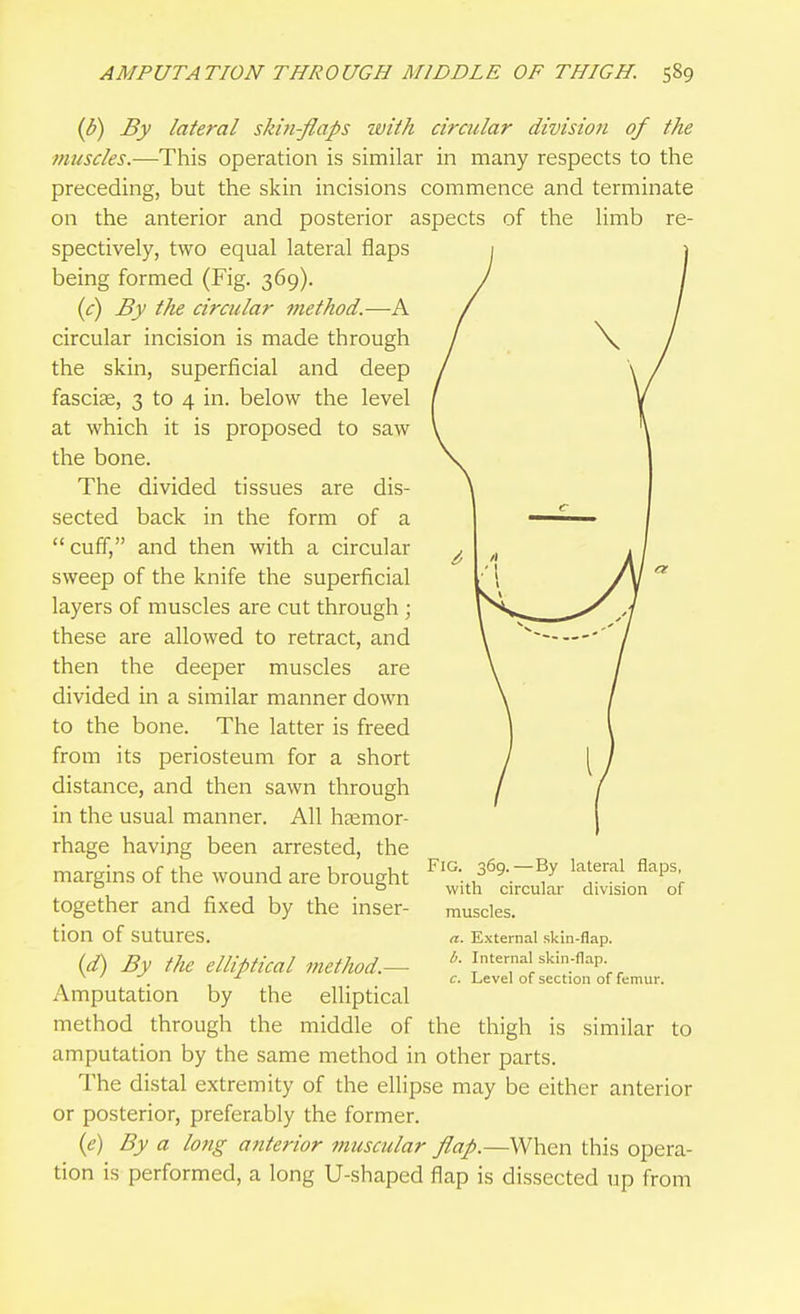{V) By lateral skin-flaps with circular division of the muscles.—This operation is similar in many respects to the preceding, but the skin incisions commence and terminate on the anterior and posterior aspects of the Umb re- spectively, two equal lateral flaps being formed (Fig. 369). {c) By the circular method.—A circular incision is made through the skin, superficial and deep fasciae, 3 to 4 in. below the level at which it is proposed to saw the bone. The divided tissues are dis- sected back in the form of a  cuff, and then with a circular sweep of the knife the superficial layers of muscles are cut through ; these are allowed to retract, and then the deeper muscles are divided in a similar manner down to the bone. The latter is freed from its periosteum for a short distance, and then sawn through in the usual manner. All heemor- rhage having been arrested, the margins of the wound are brought together and fixed by the inser- tion of sutures. {d) By the elliptical method.— Amputation by the elliptical method through the middle of the thigh is similar to amputation by the same method in other parts. The distal extremity of the ellipse may be either anterior or posterior, preferably the former. {e) By a long anterior muscular flap.—When this opera- tion is performed, a long U-shaped flap is dissected up from Fig. 369.—By lateral flaps, with circular division of muscles. a. External skin-flap. b. Internal skin-flap. c. Level of section of femur.